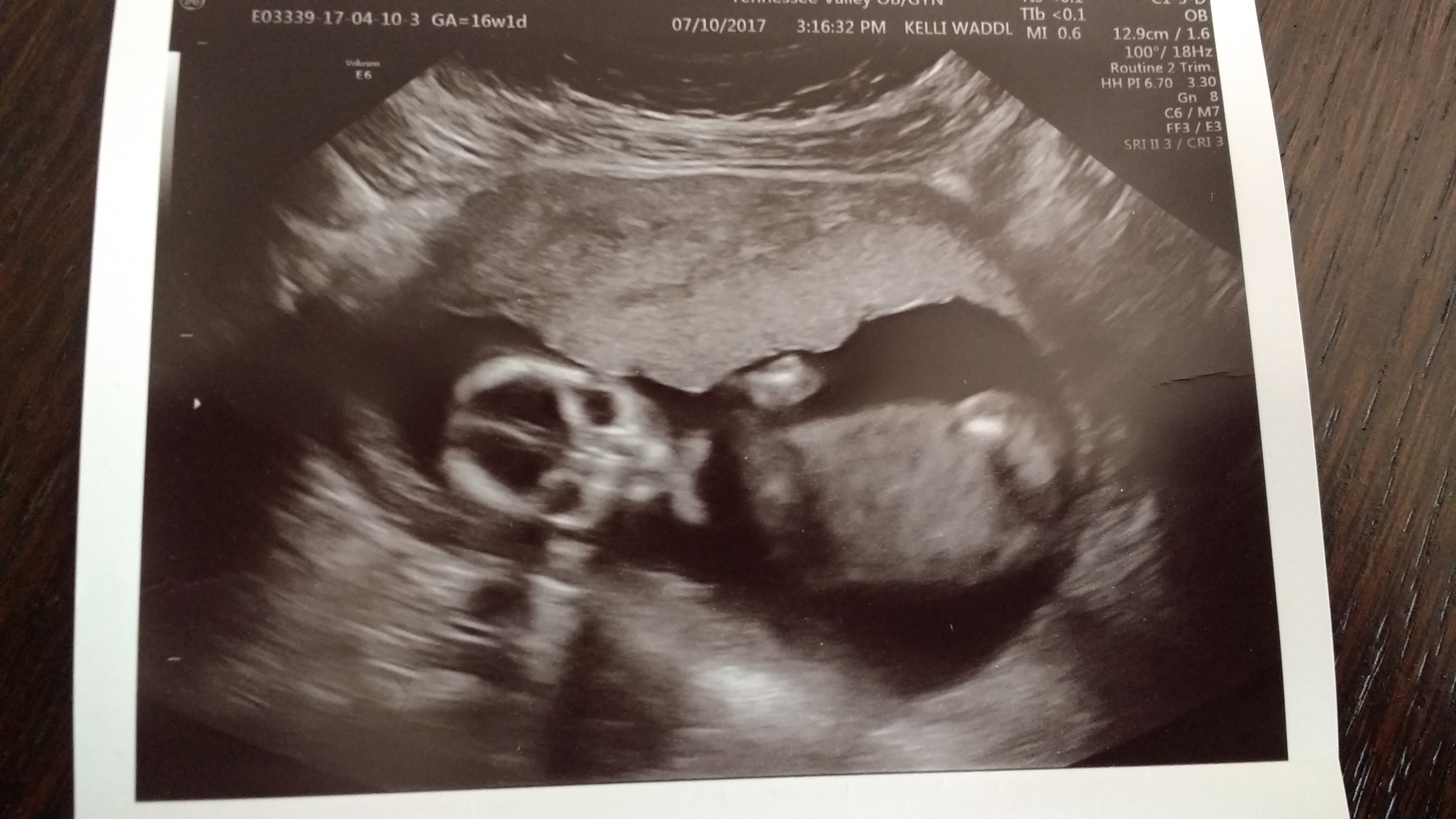 Creepy ultrasound picture!! - December 2017 Babies | Forums | What ...