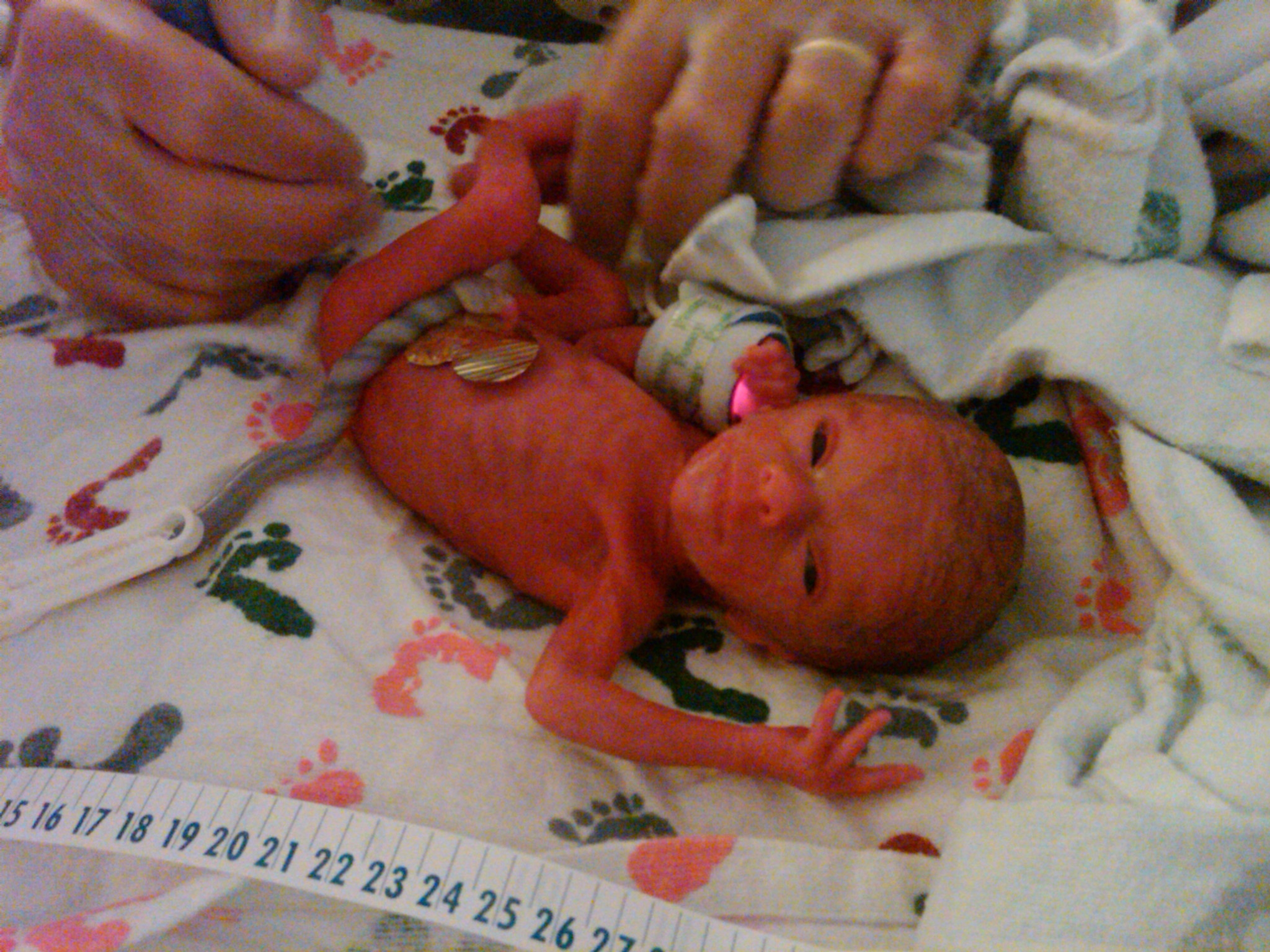 Kaitlyn Is Born! (Dad's Story) | miraclekaitlyn