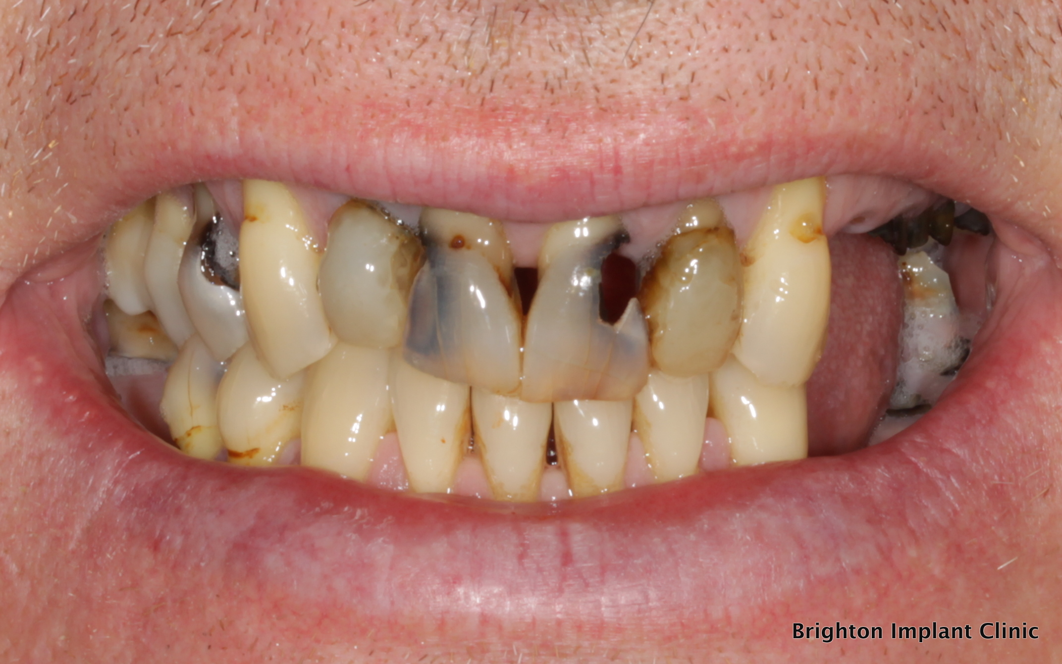 Bad Teeth | Decayed teeth affected : Dental Implants