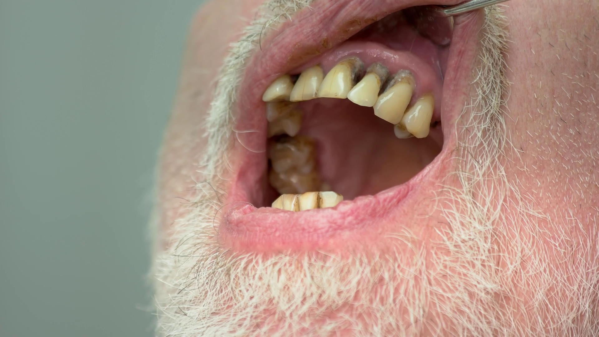 Bad teeth close up. Dental examination procedure. Symptoms of caries ...