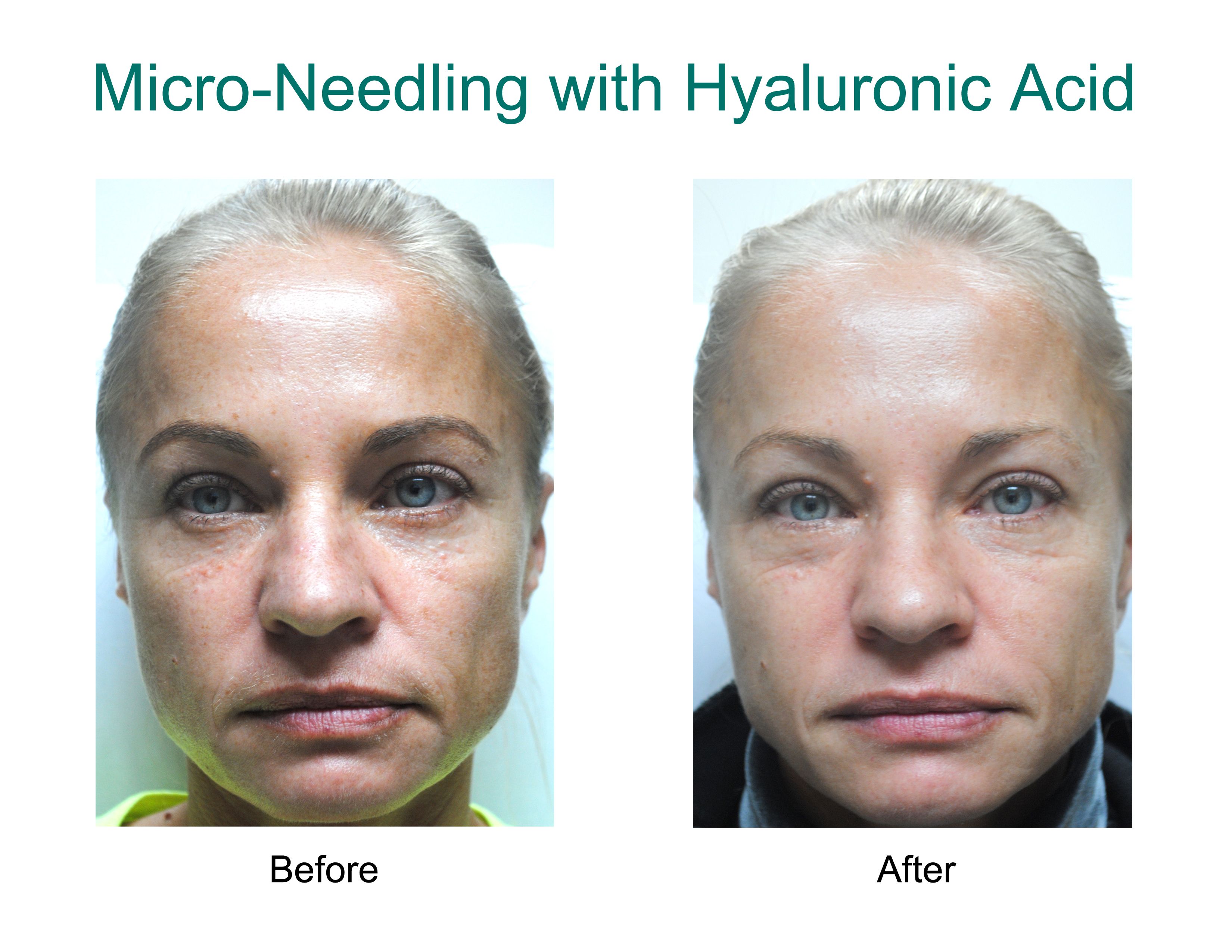 Before and after photos showing #results from Micro-Needling with ...