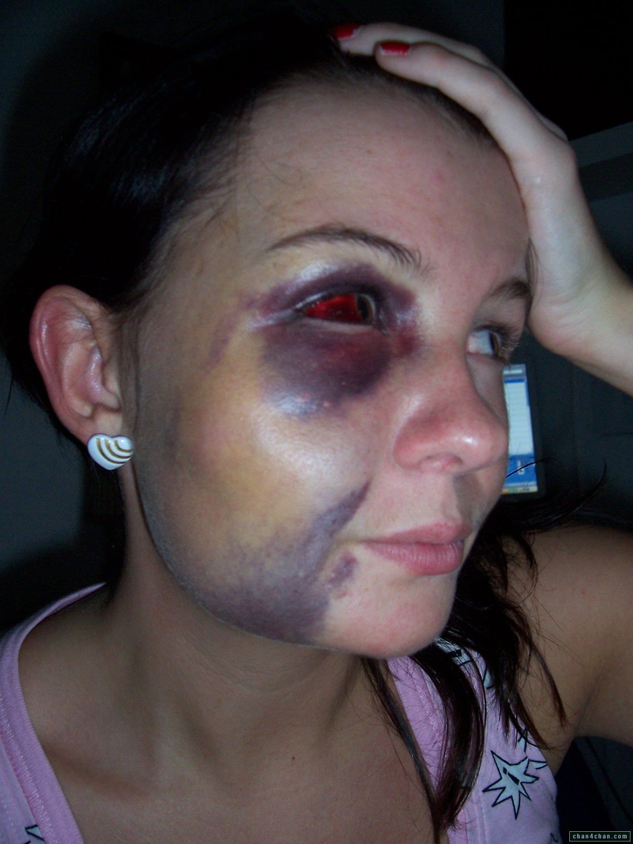 Any woman here ever had a black eye from a man? - Bodybuilding.com ...