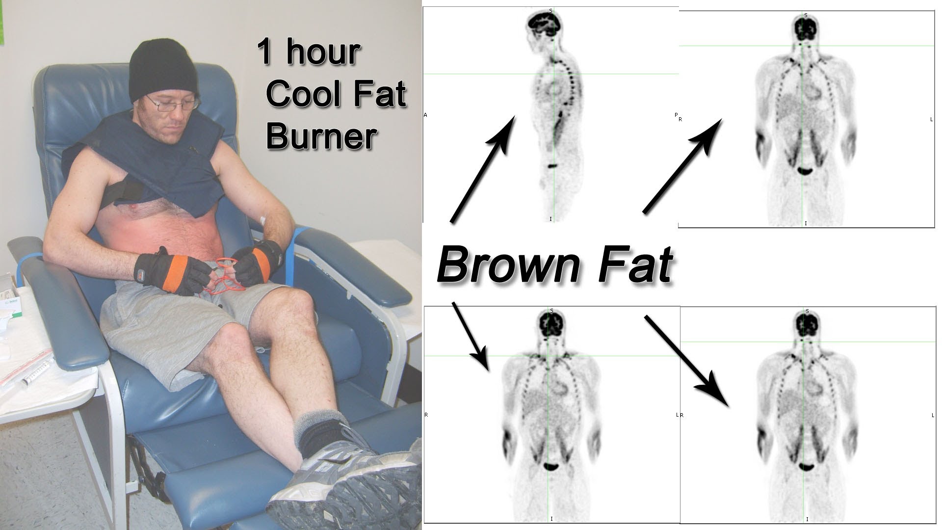 The Cool Fat Burner activates brown fat! - Cool Fat Burner, LLC