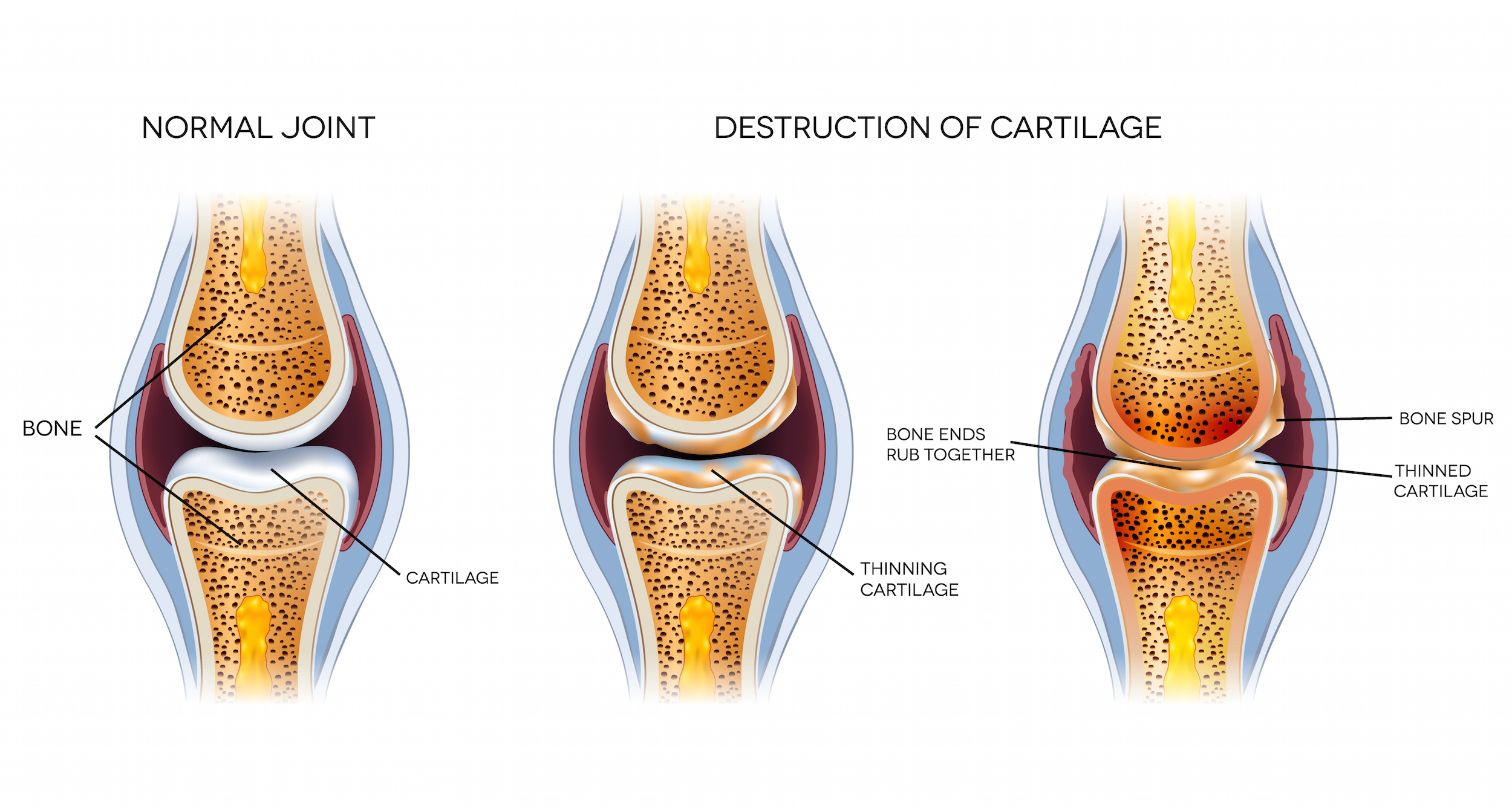 New Ways to Grow Cartilage | Osteoarthritis Research