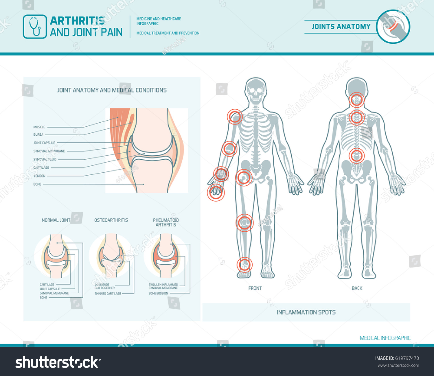 Rheumatoid Arthritis Osteoarthritis Joint Pain Infographic Stock ...