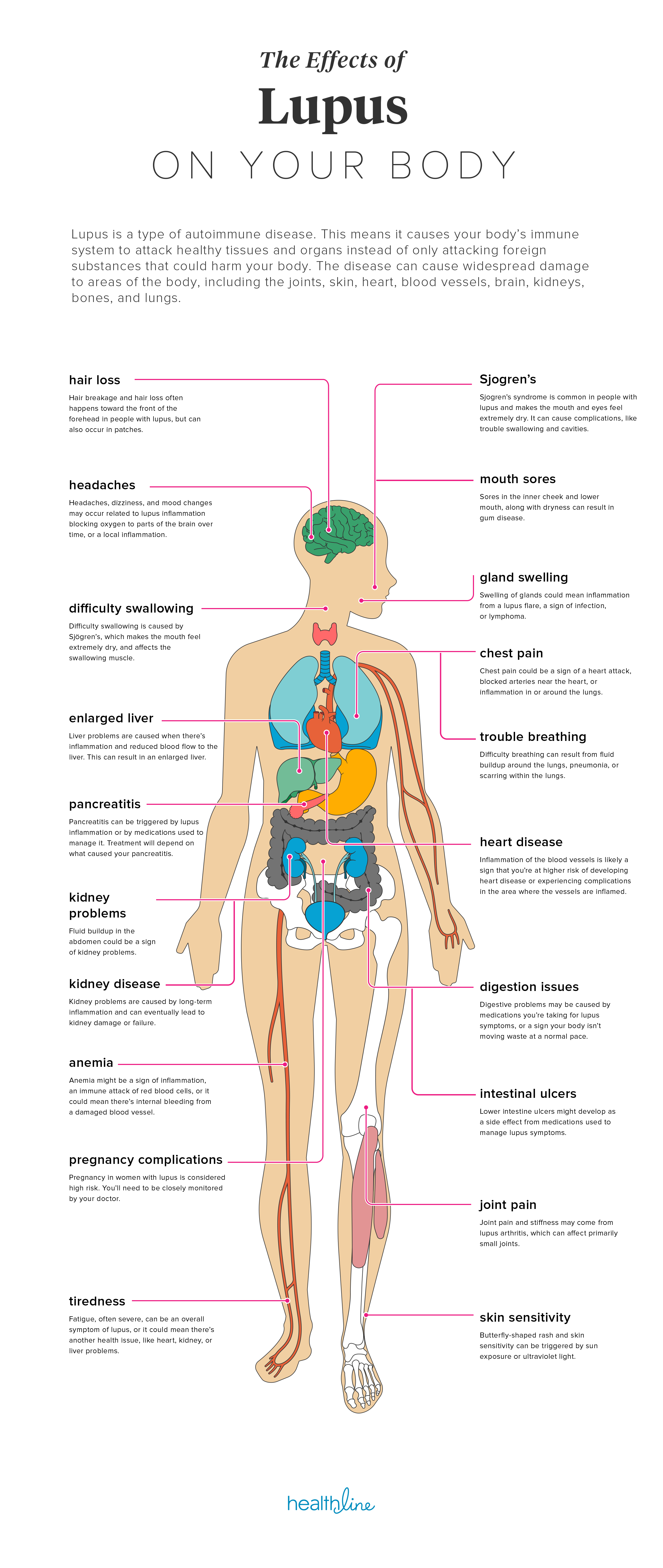 The Effects of Lupus on the Body