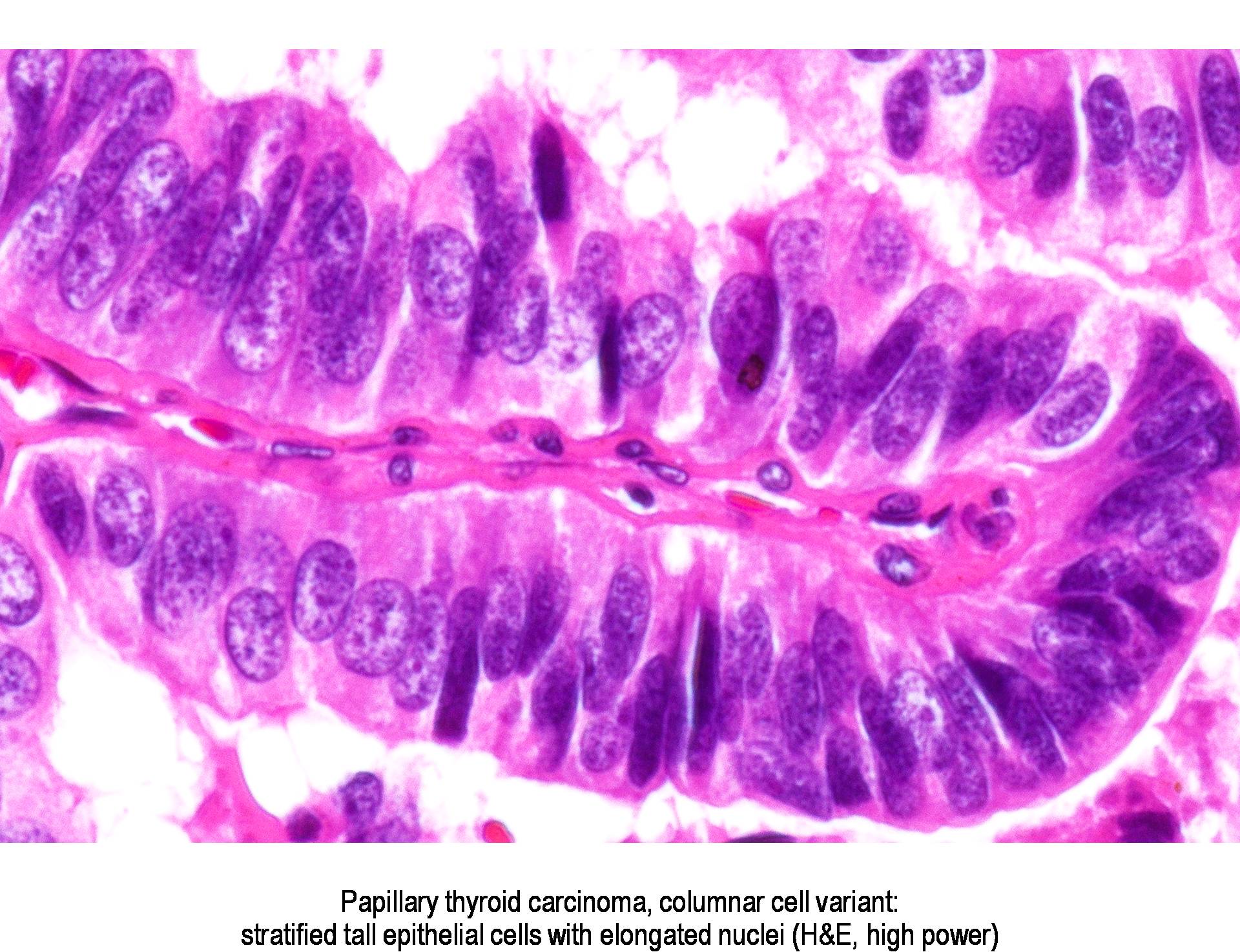 Pathology Outlines - Columnar cell variant