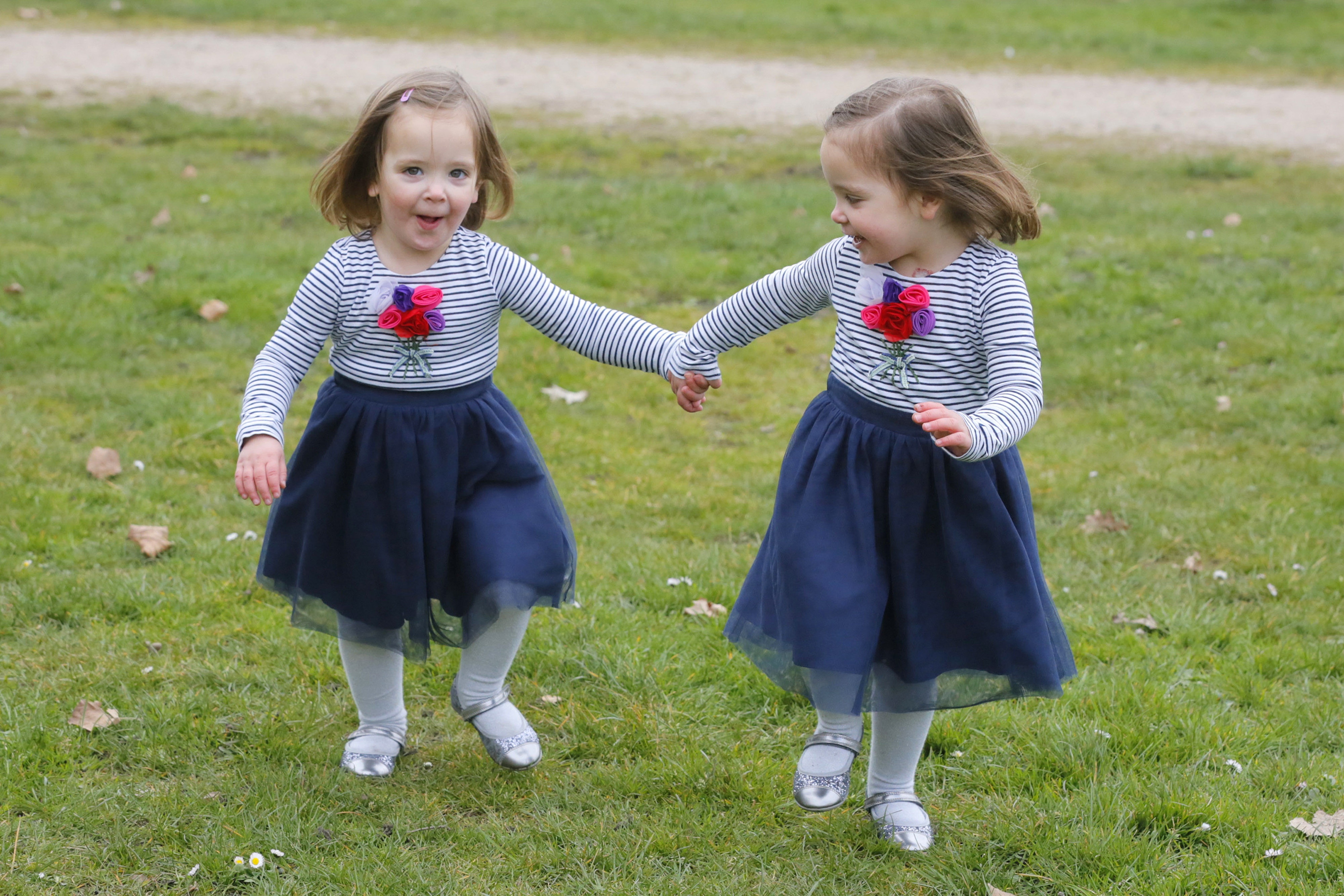 Conjoined twins separated - show they're still as close as ever