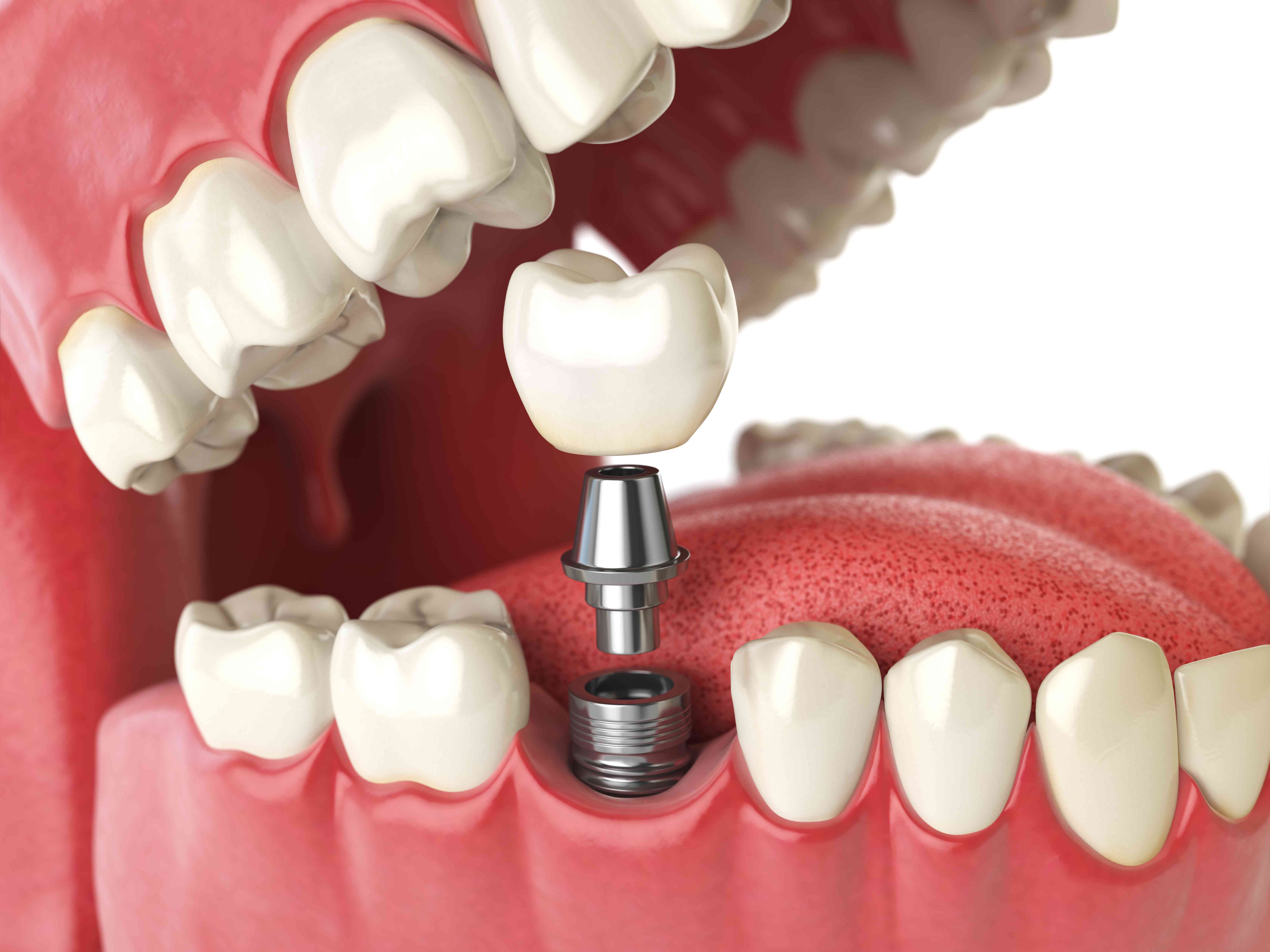 Prosthetic Dentistry and the Different Dental Solutions