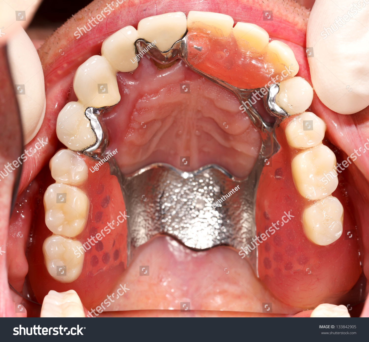 Dental Prosthesis Upper Denture Mouth Stock Photo (Royalty Free ...