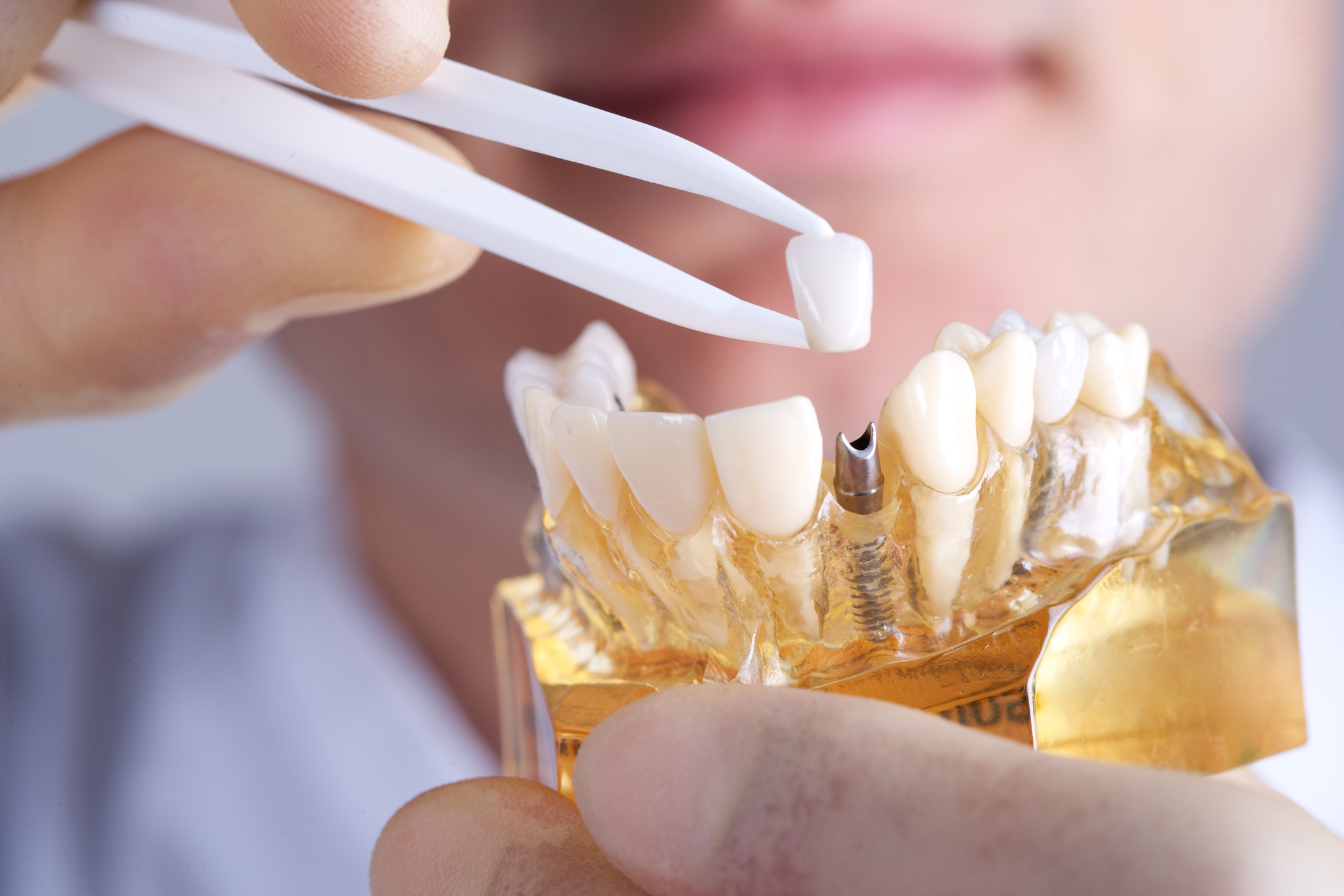 Everything You Need to Know About Dental Prosthetics
