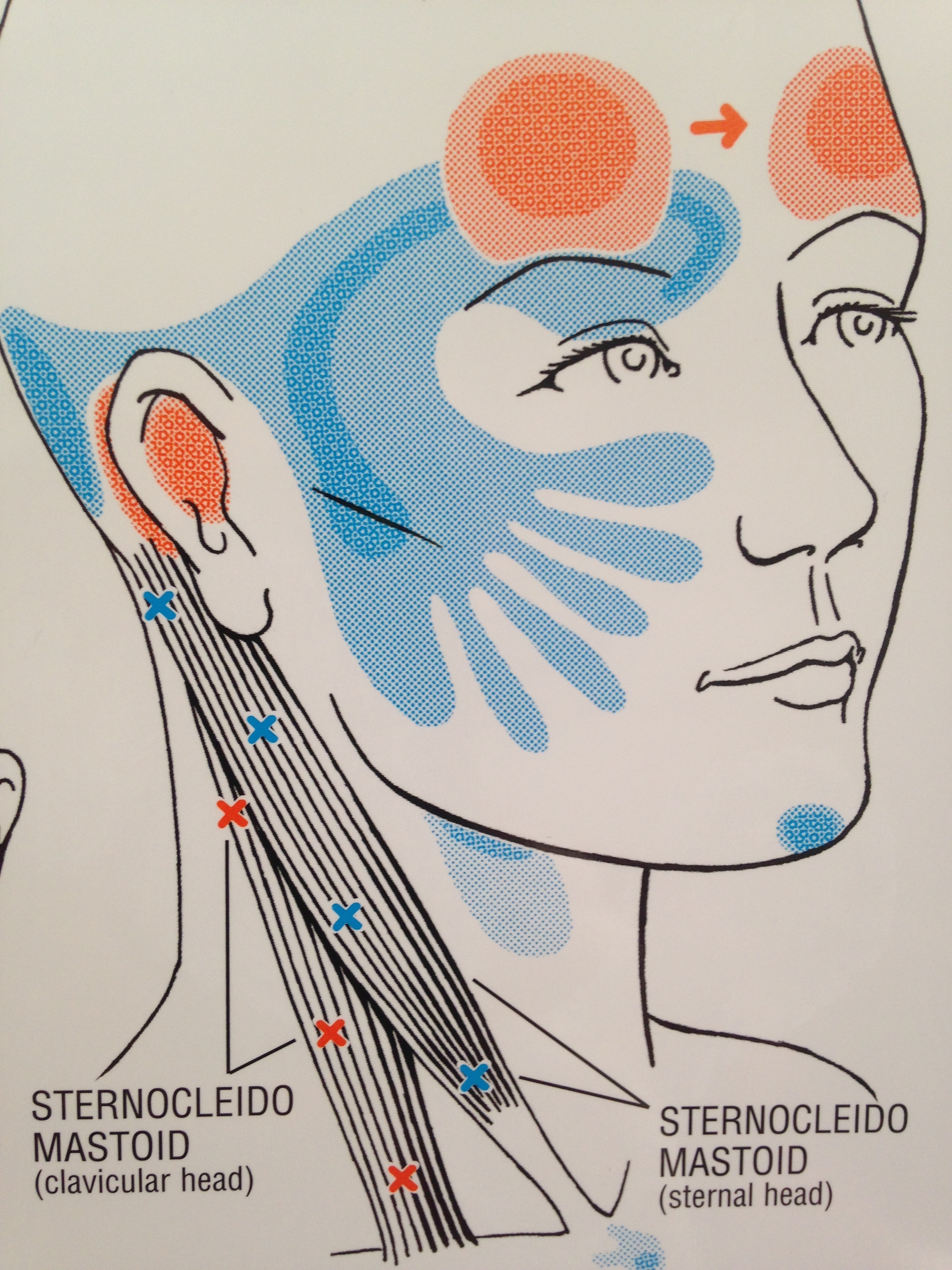 Headaches and Trigger Points - Shiatsu Massage - Martin Gibbens LMT ...
