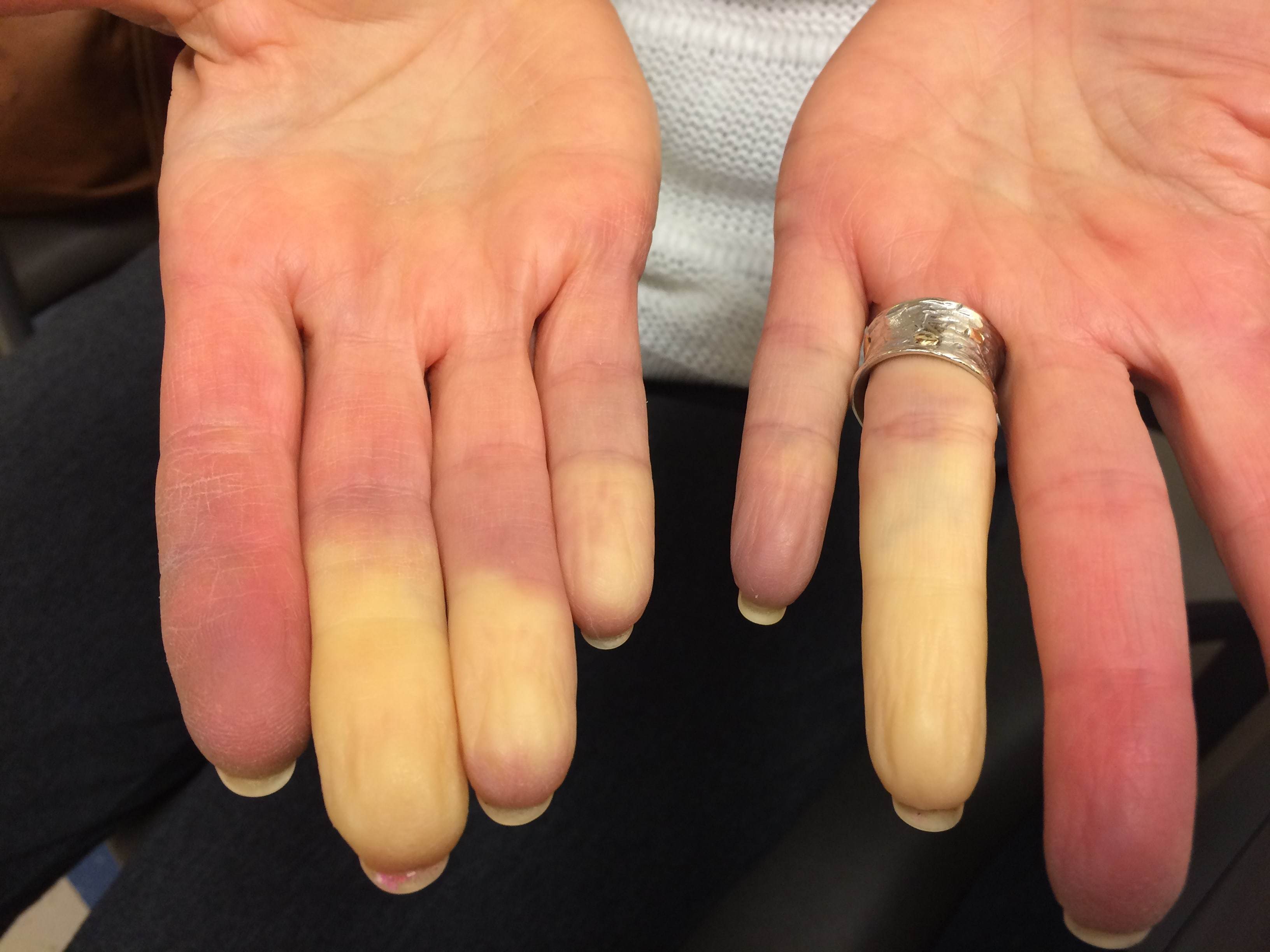 White and Blue Fingers and Toes? What's the… | Brigham Health Hub