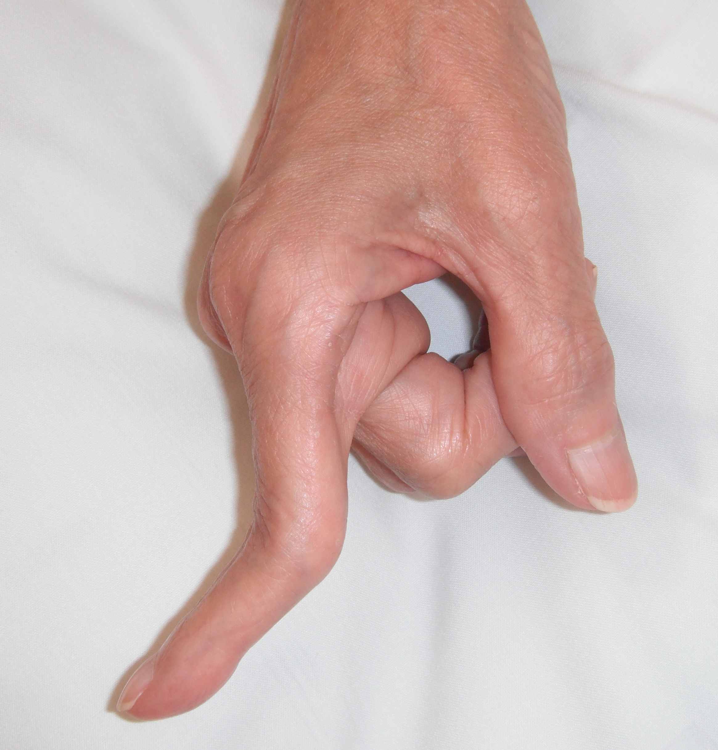 Rheumatoid Fingers | The Bone School