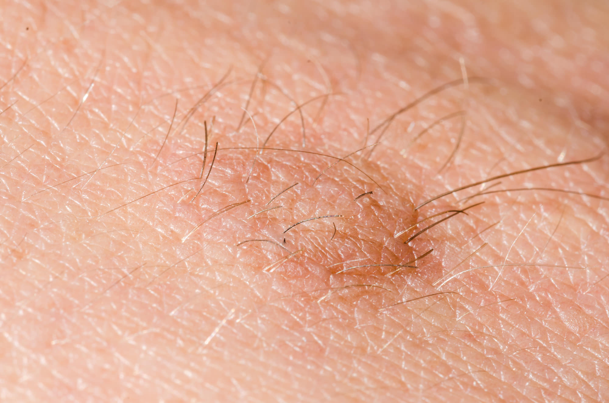 Understanding Skin Tags: Causes, Dangers & Solutions