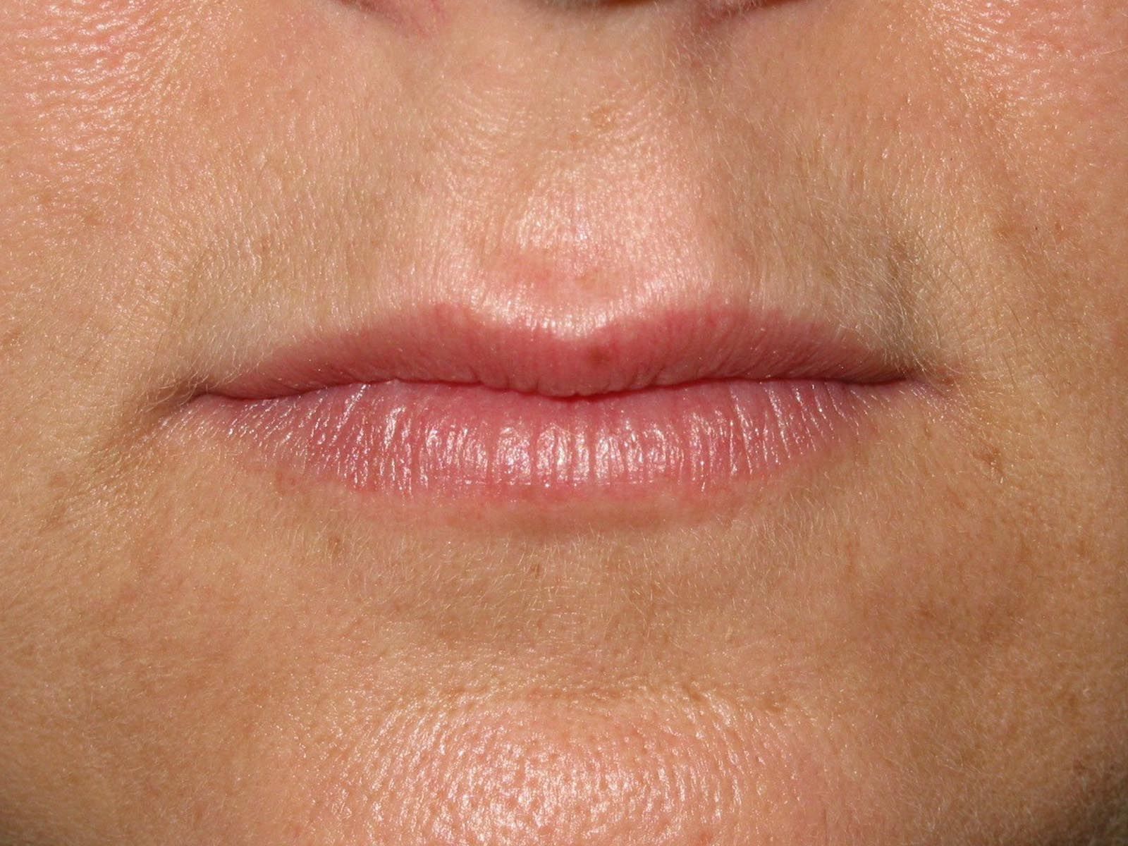 Lip-enhancement-before.jpg (1600×1200) | lips | Pinterest | Lips and ...