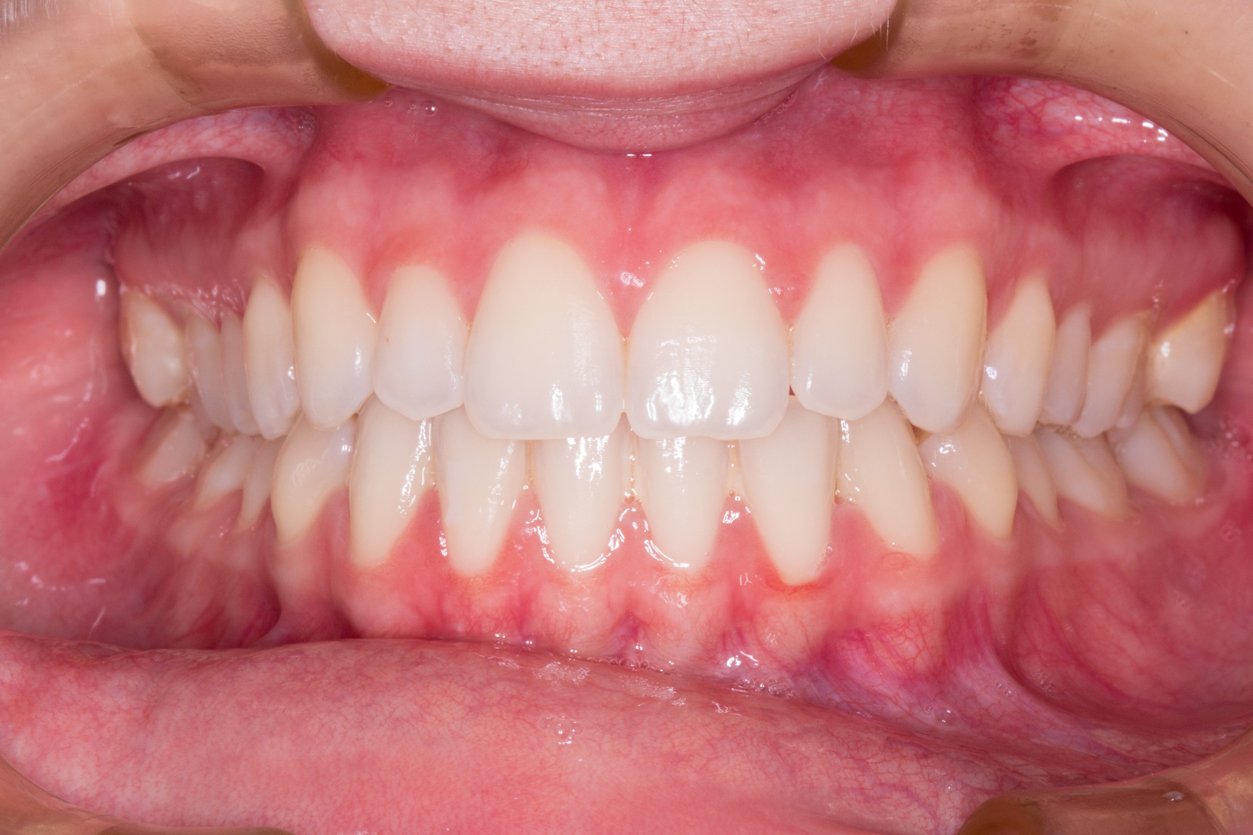 Four Different Types Of Teeth & Their Function | (Article) | DentalBlog