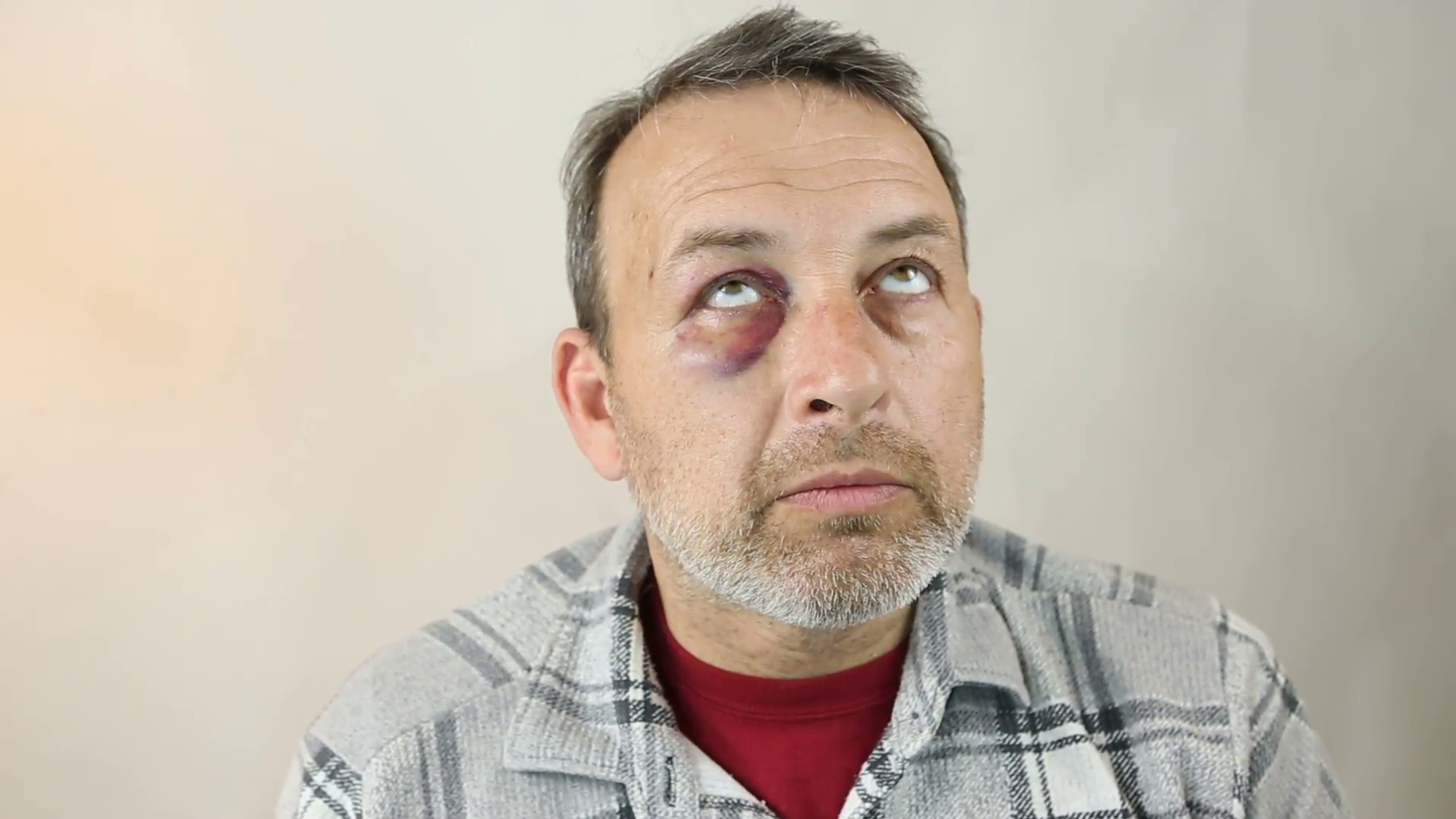 Man with Black Eye, Shiner. Man's face after the fight and assault ...