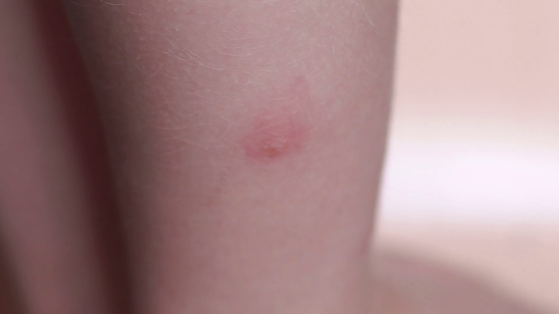 Mosquito bite on the foot of a small child, close-up. Stock Video ...