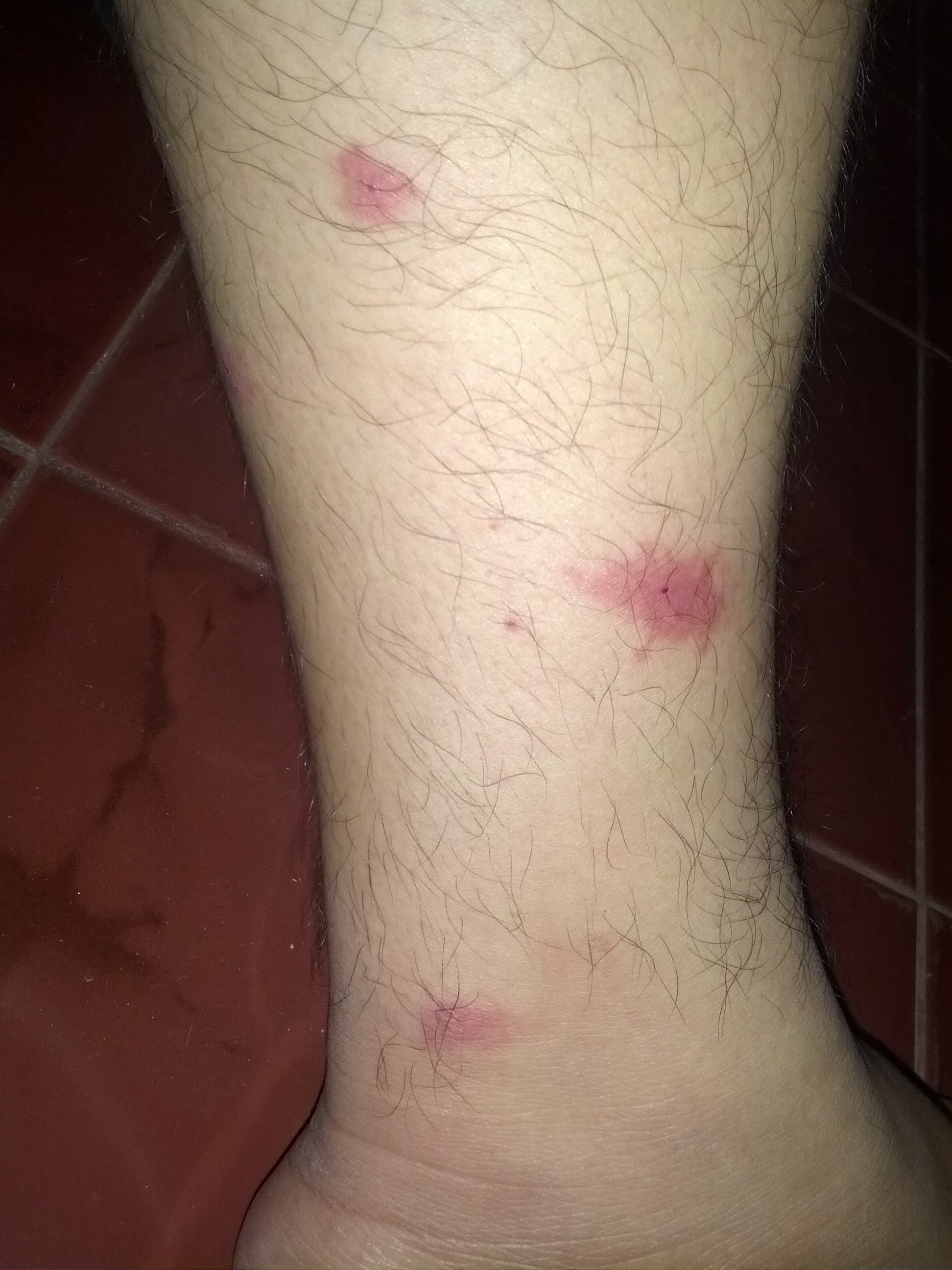 File:Mosquito bites leg.jpg - Wikimedia Commons