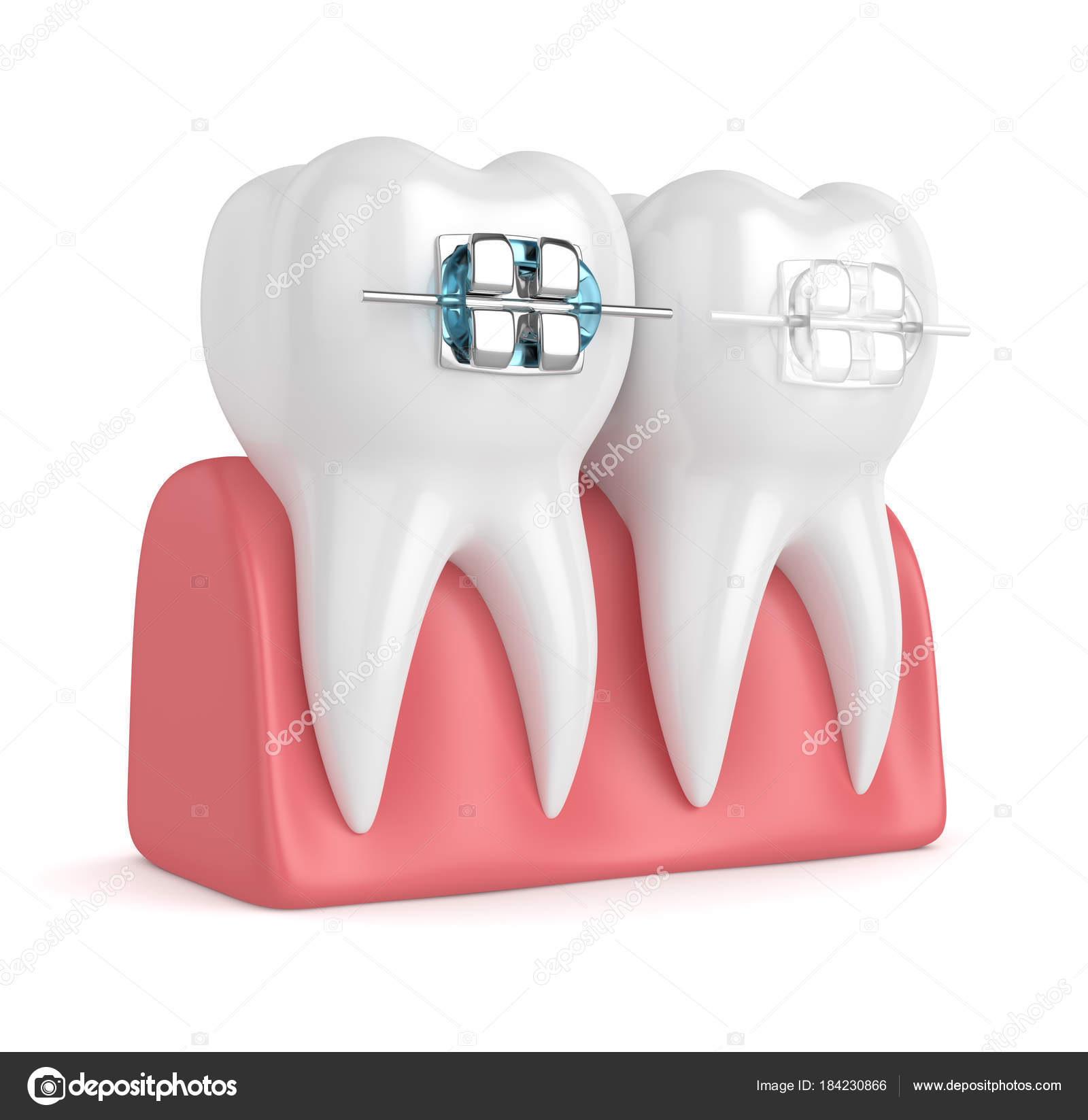3d render of teeth with ceramic and metal braces — Stock Photo ...