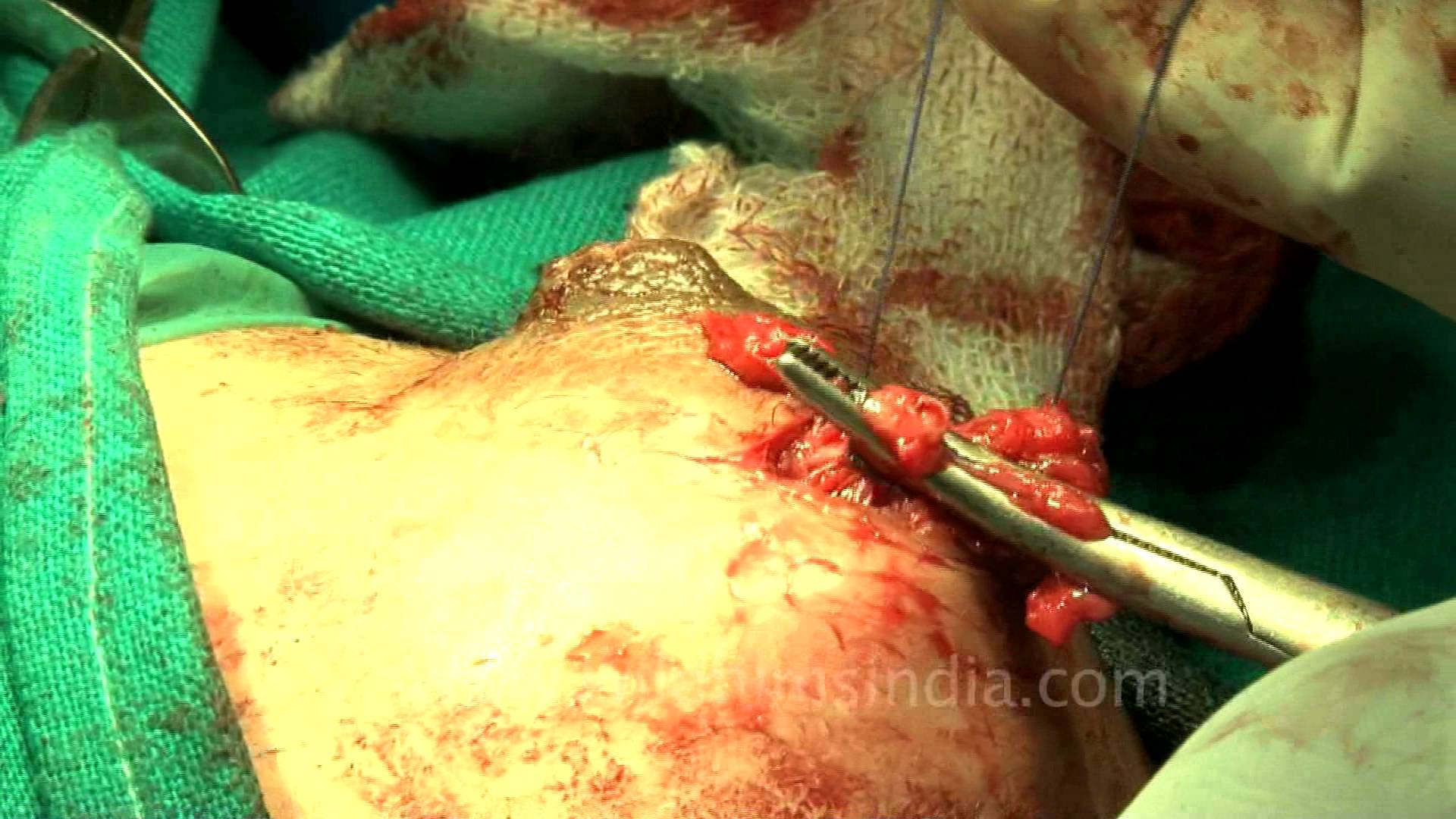 Stitching the incision after the surgery - YouTube