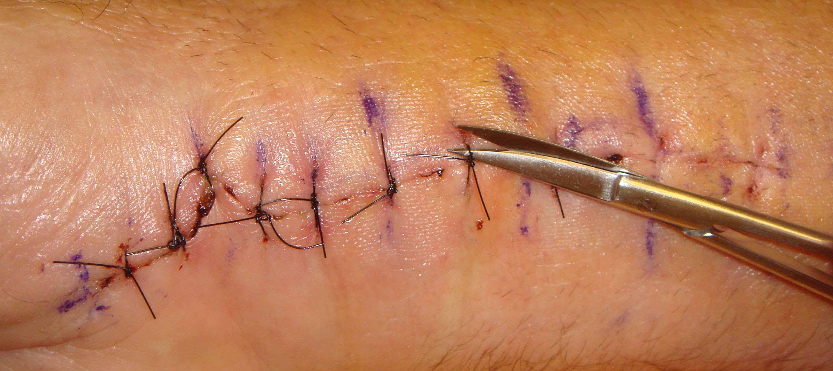 Suture Removal Protocol - YouTube
