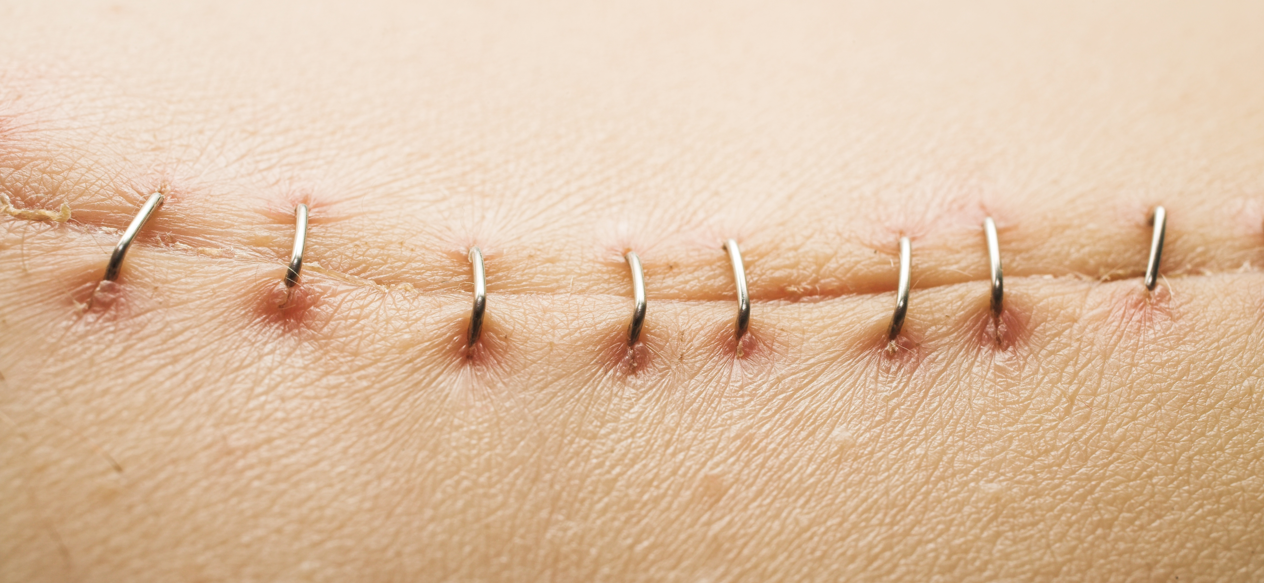 How Long Do Surgical Staples Stay In? | LIVESTRONG.COM