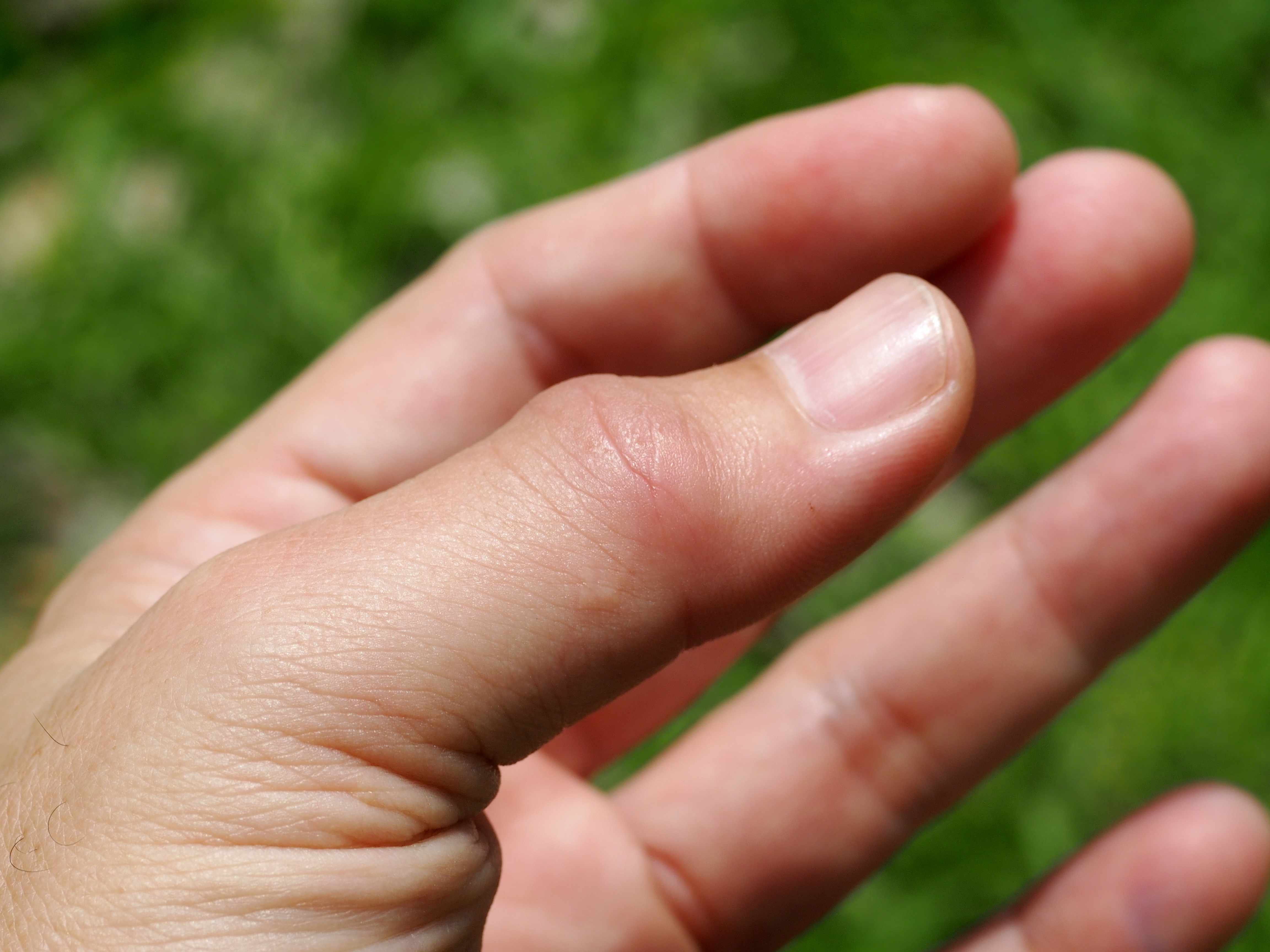 Home Remedies: Just jammed your finger? – Mayo Clinic News Network
