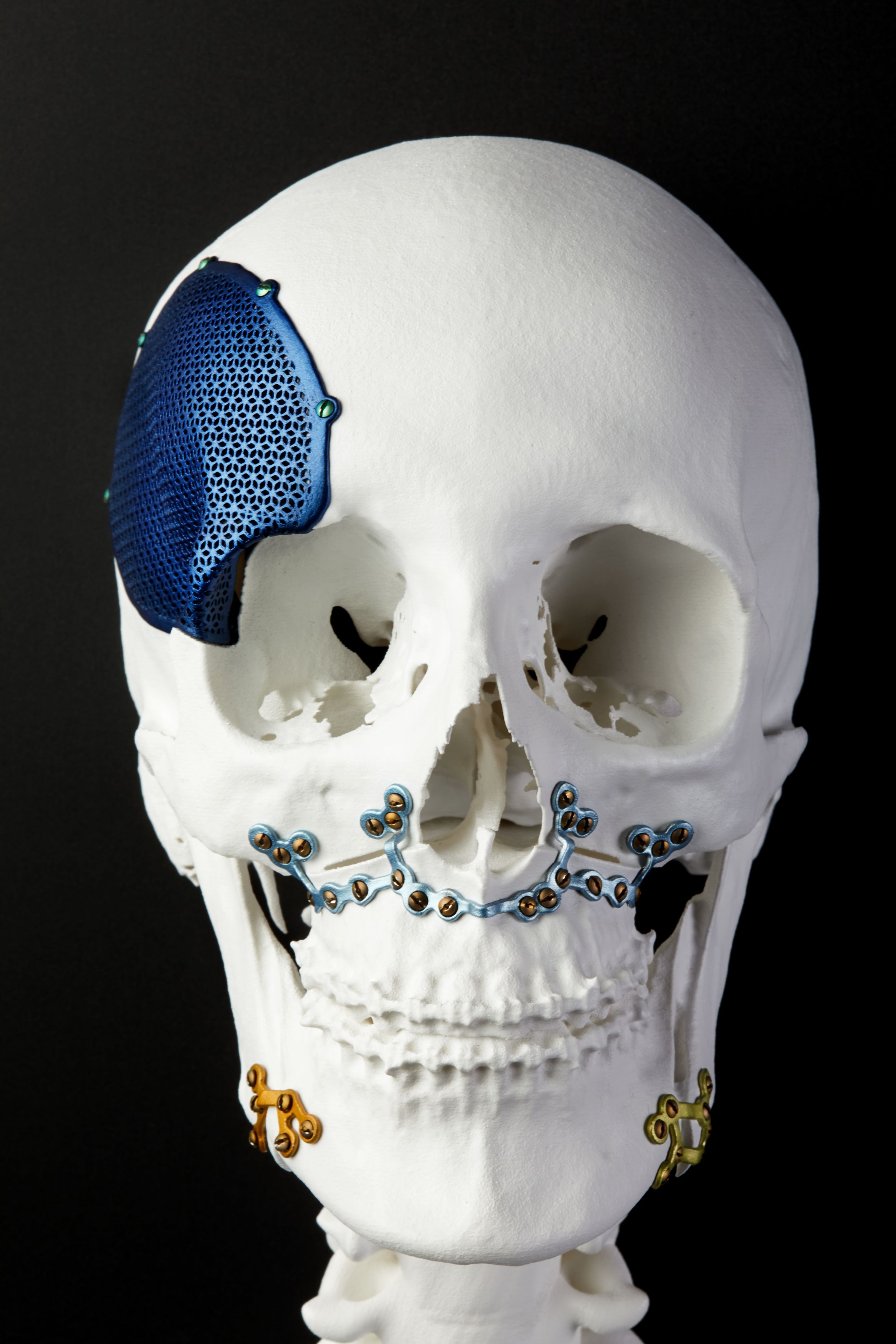 3D Printed Bone Replicas Aid In Plastic Surgery - GE