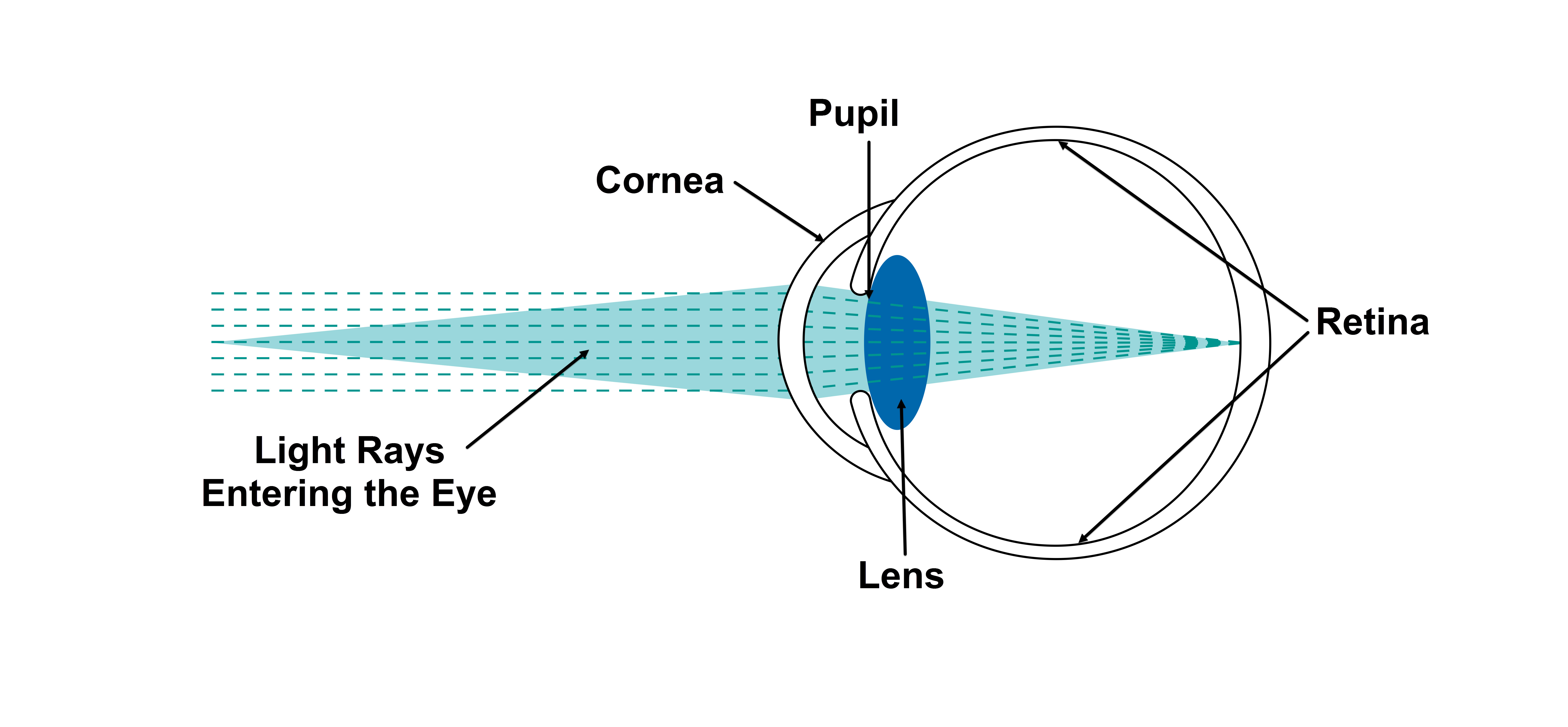 Understanding Your Vision and Cataracts | IC-8 Lens