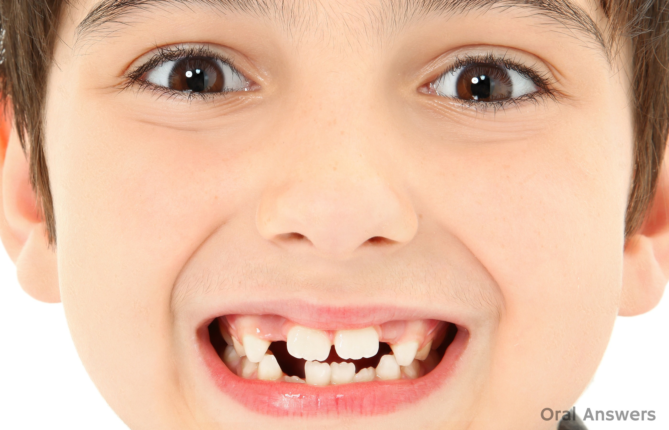 Mamelons: The Bumps On Your Child's Permanent Teeth Are Normal ...
