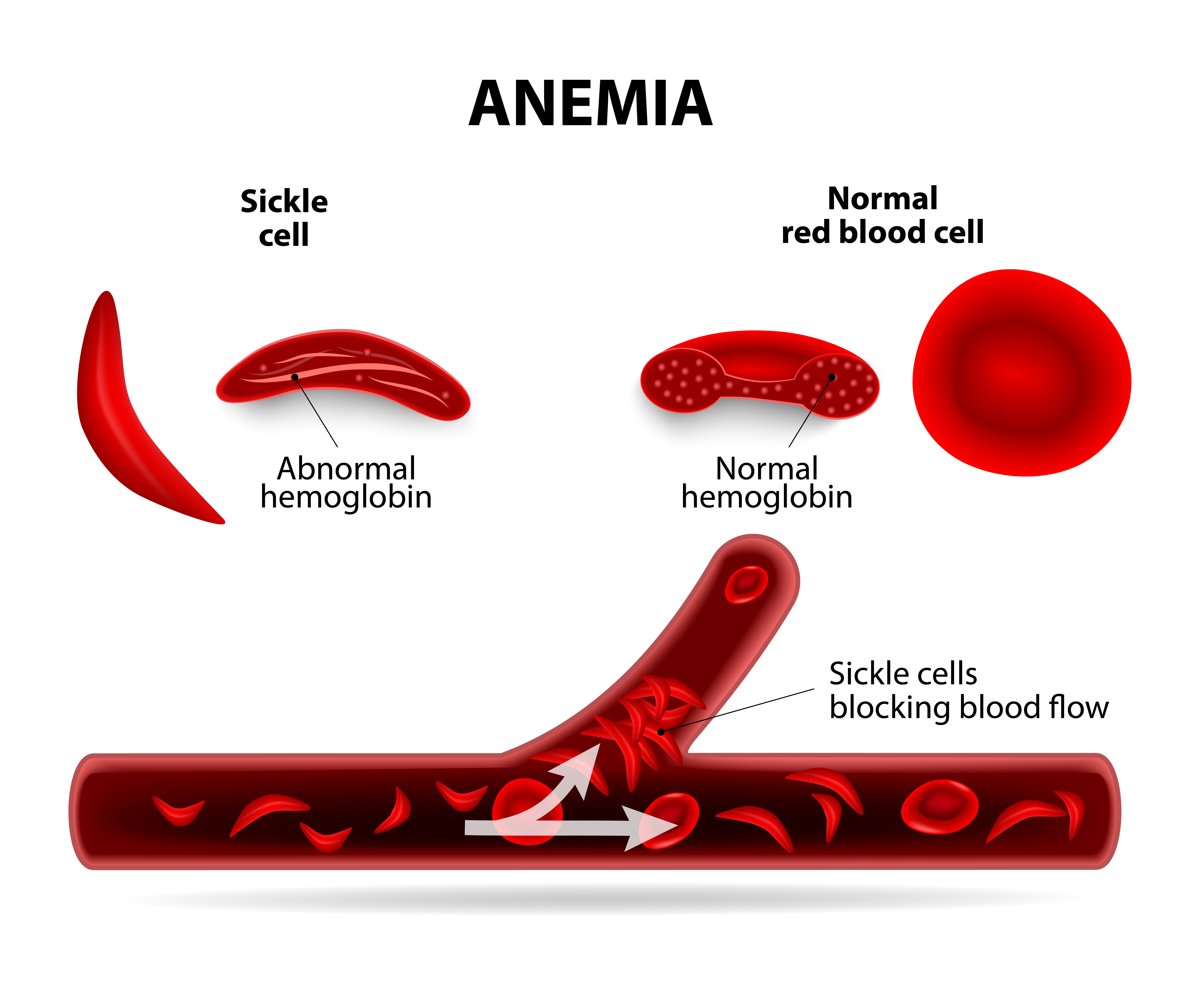 Sickle cell anemia photo