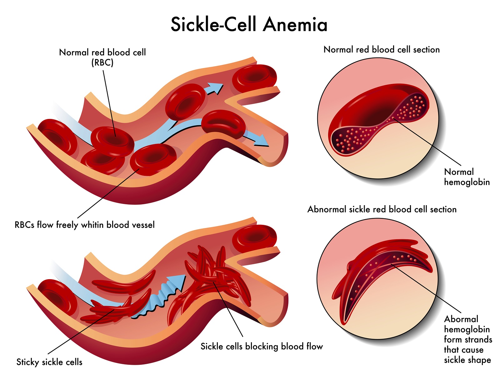 Tennessee Health Department warns of Sickle Cell disease ...