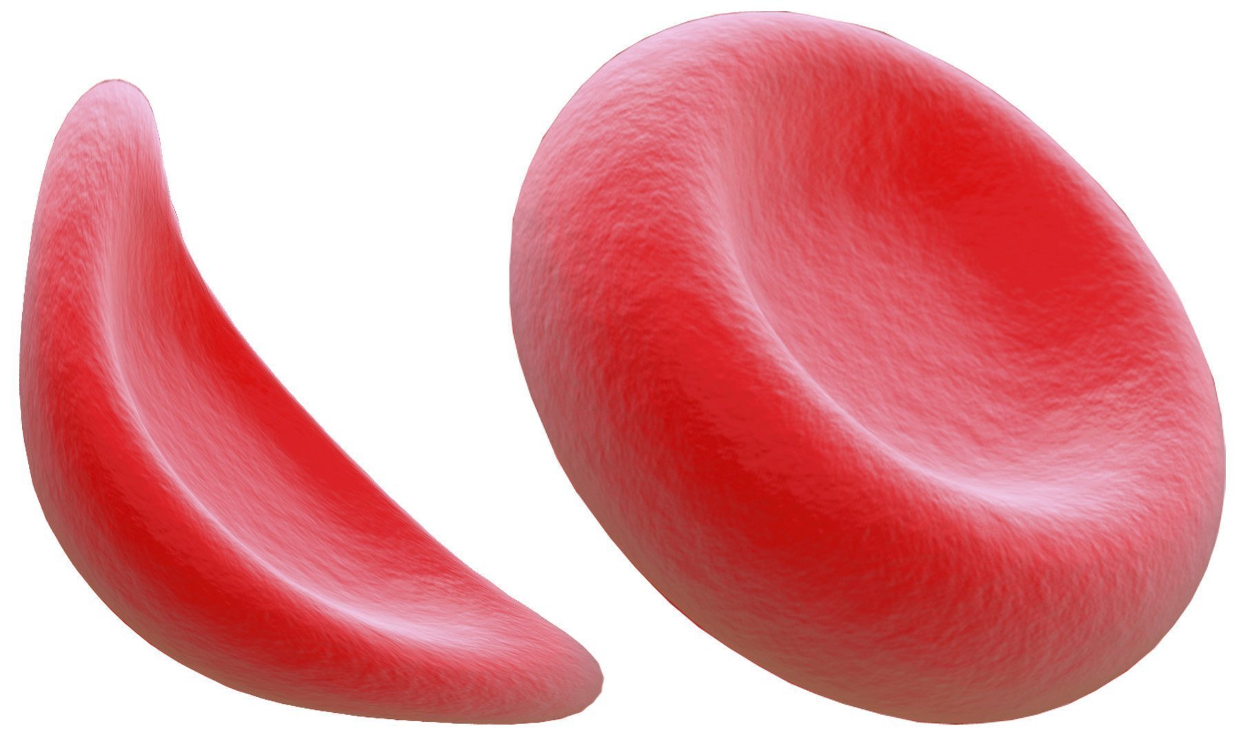 Sickle cell anemia patients can live normal lives - The San Diego ...