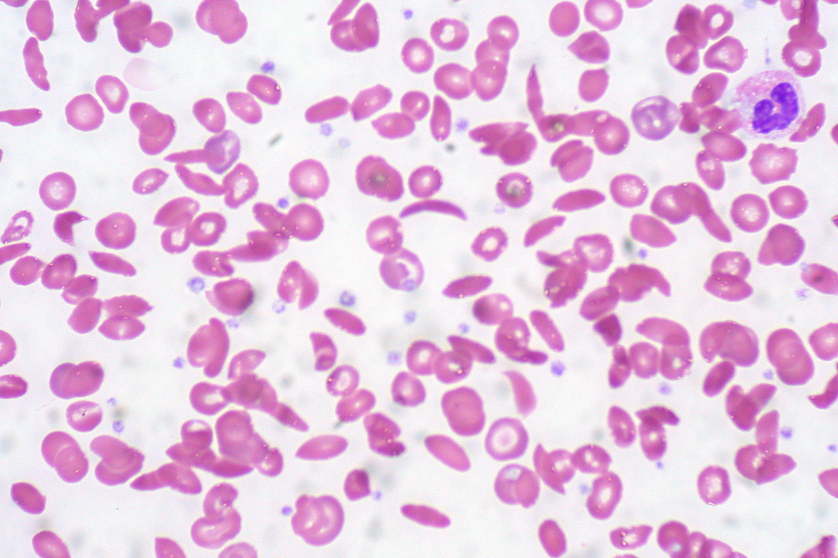 What's Causing Heart Complications in Sickle Cell Anemia Pat