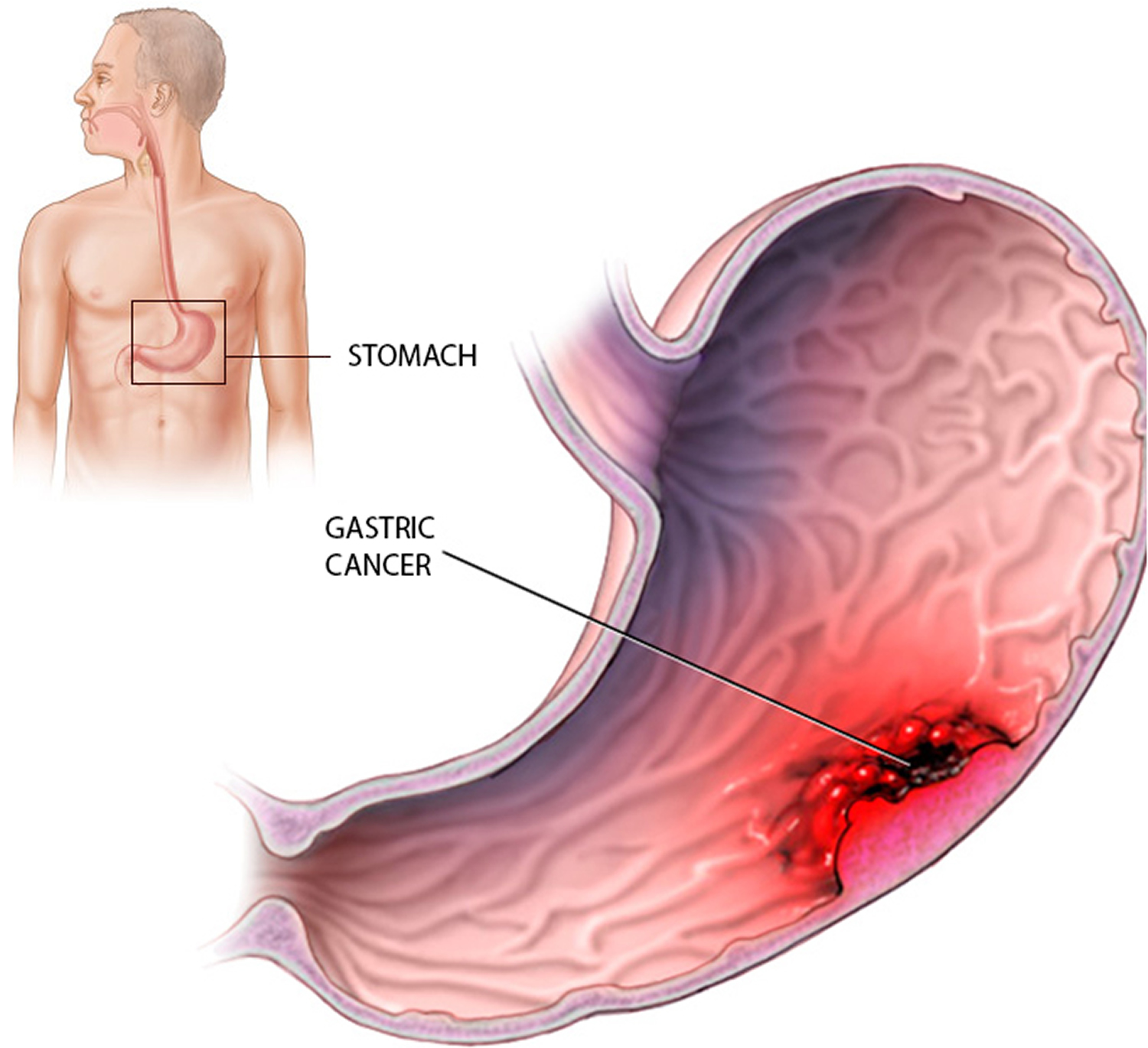 Stomach Cancer - Causes, Symptoms, Diagnosis and Treatment