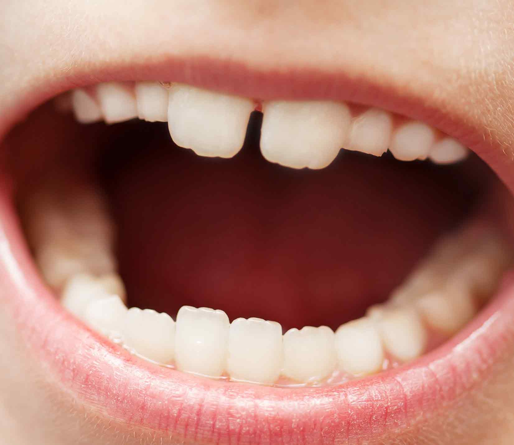 Grooves on Your Child's New Permanent Teeth? | Southwood Dental Studio