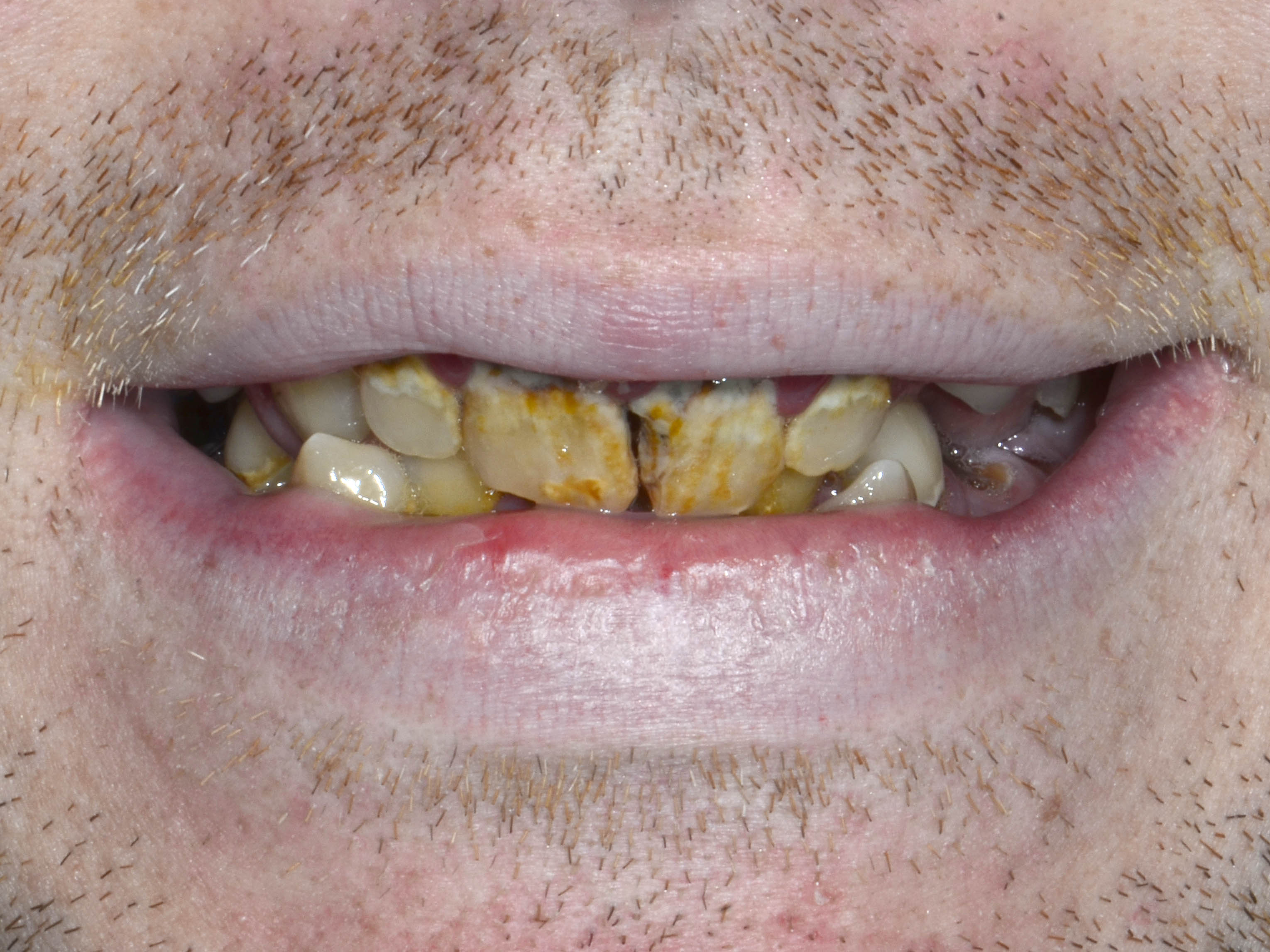 Teeth in an Hour | St. Louis, MO | St. Louis Dental Implants
