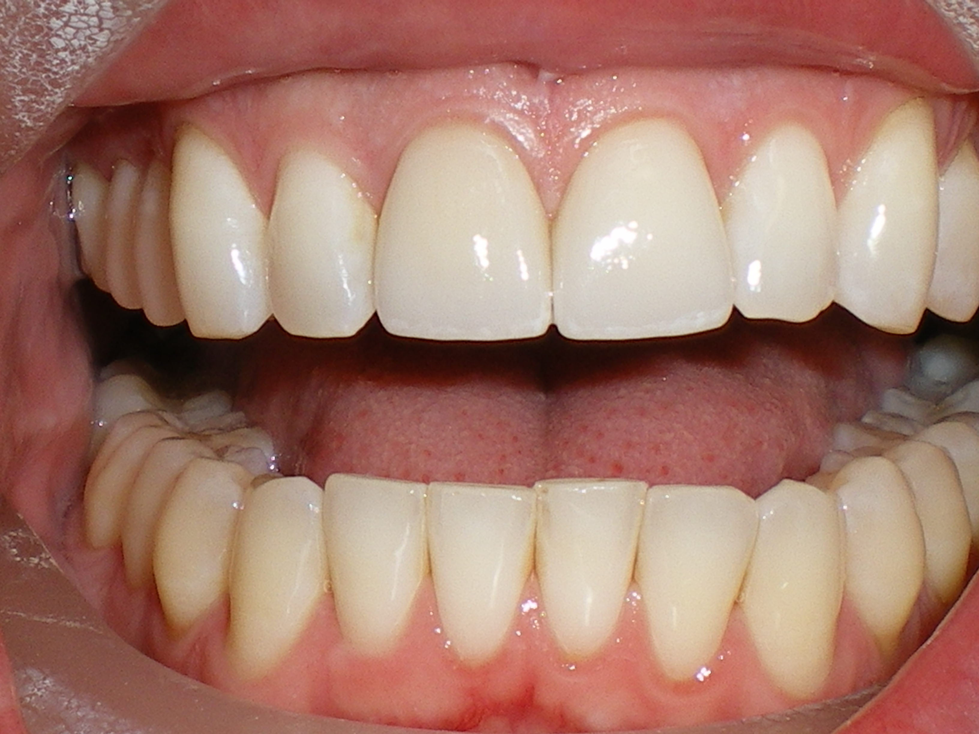 Root Canal Front Teeth | School | Pinterest | Teeth
