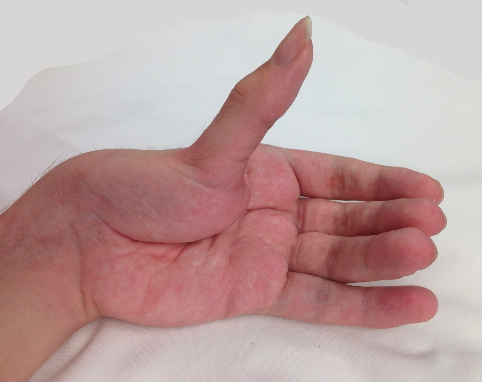 Cerebral Palsy, Thumb Deformity | Congenital Hand and Arm Differences