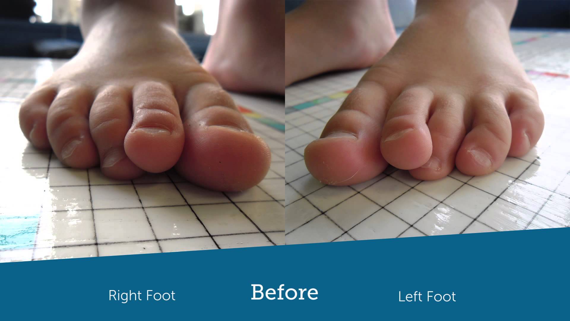 Correct Toes Helps Child with Crooked Toes - YouTube