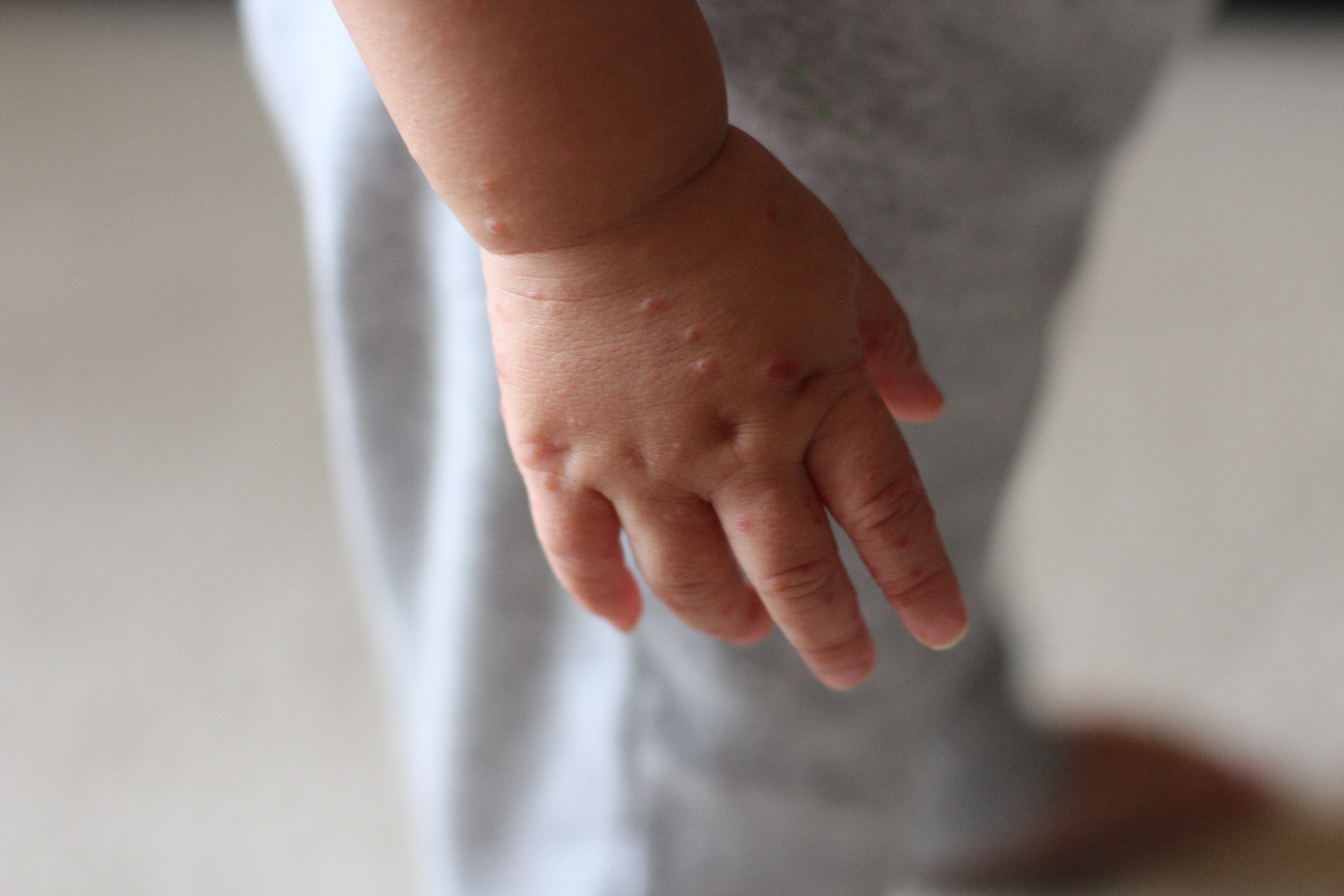 Hand, Foot & Mouth Disease - Every (Working) Mom's Nightmare - Diary ...