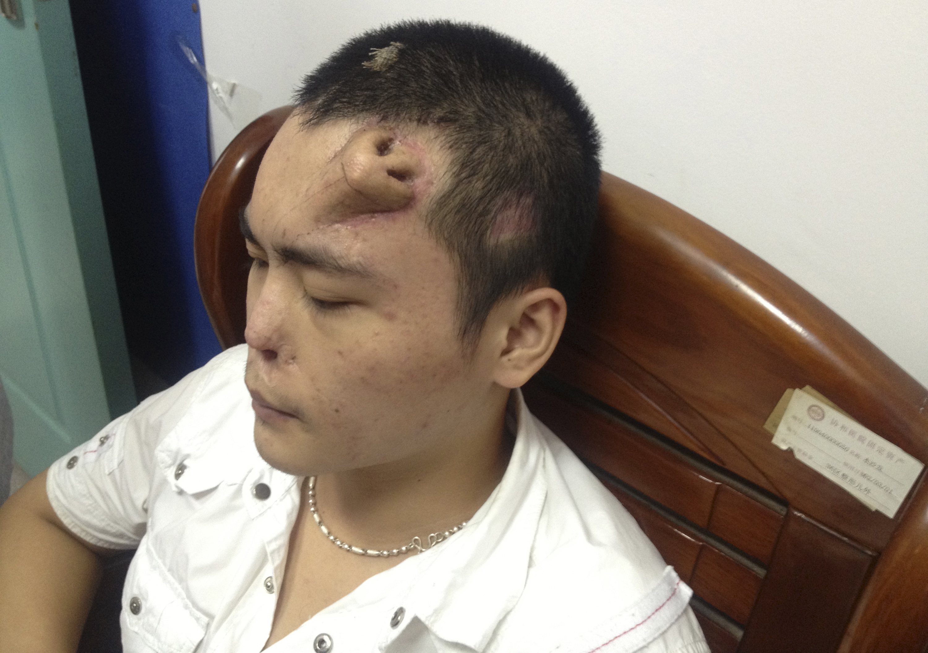 Chinese Man Has Nose Grown On Forehead After Injury In Car Accident ...