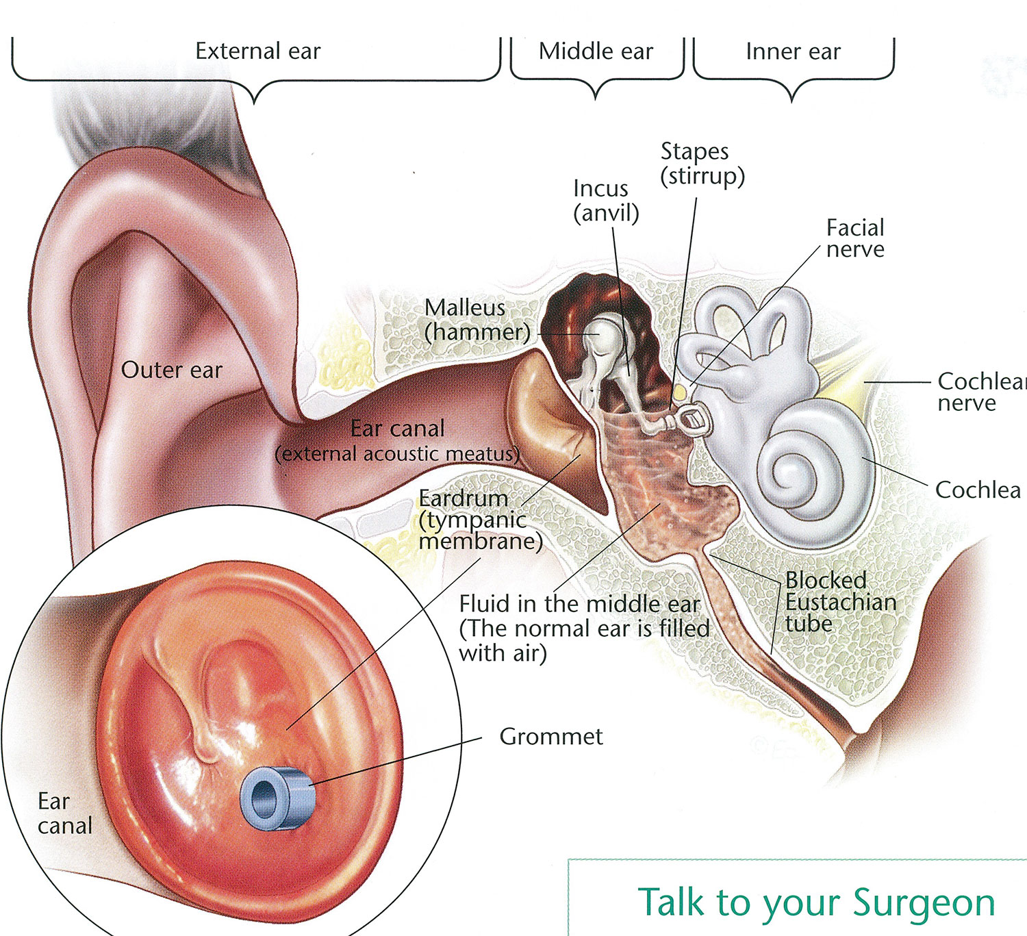 Middle ear ventilation tubes (grommets) - Dr Bridget Clancy | ENT ...
