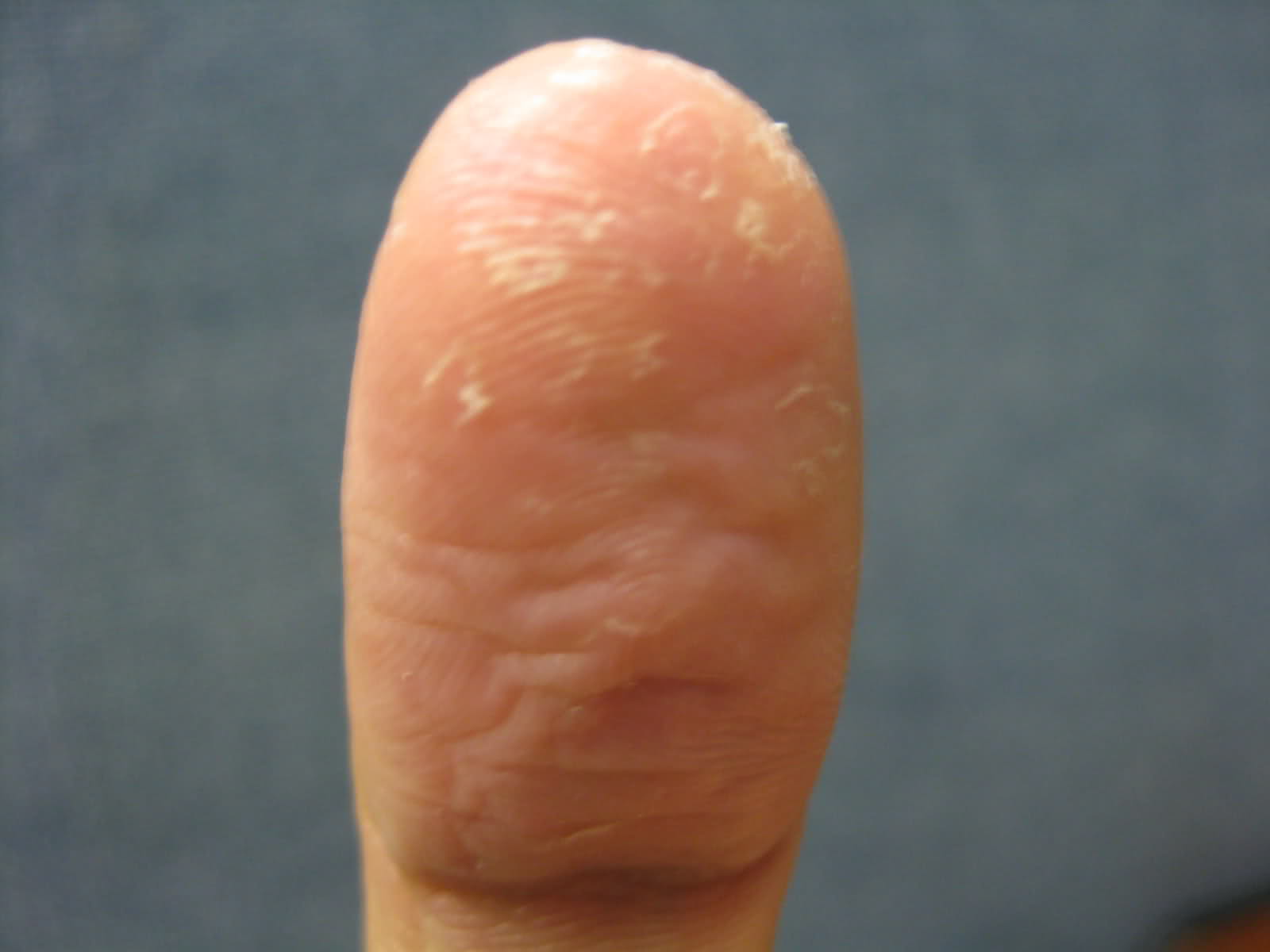 SORE AND PEELING FINGERTIPS | Skin Itching & Rashes discussions ...