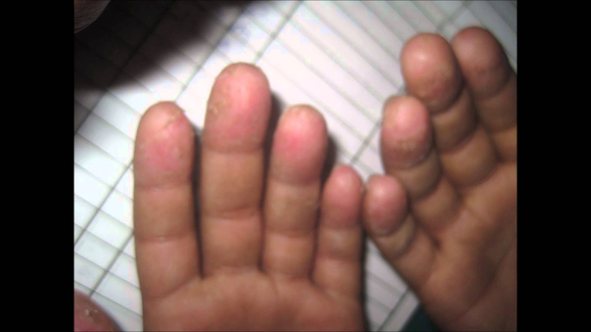 Peeling Of Skin At Finger Tips - YouTube