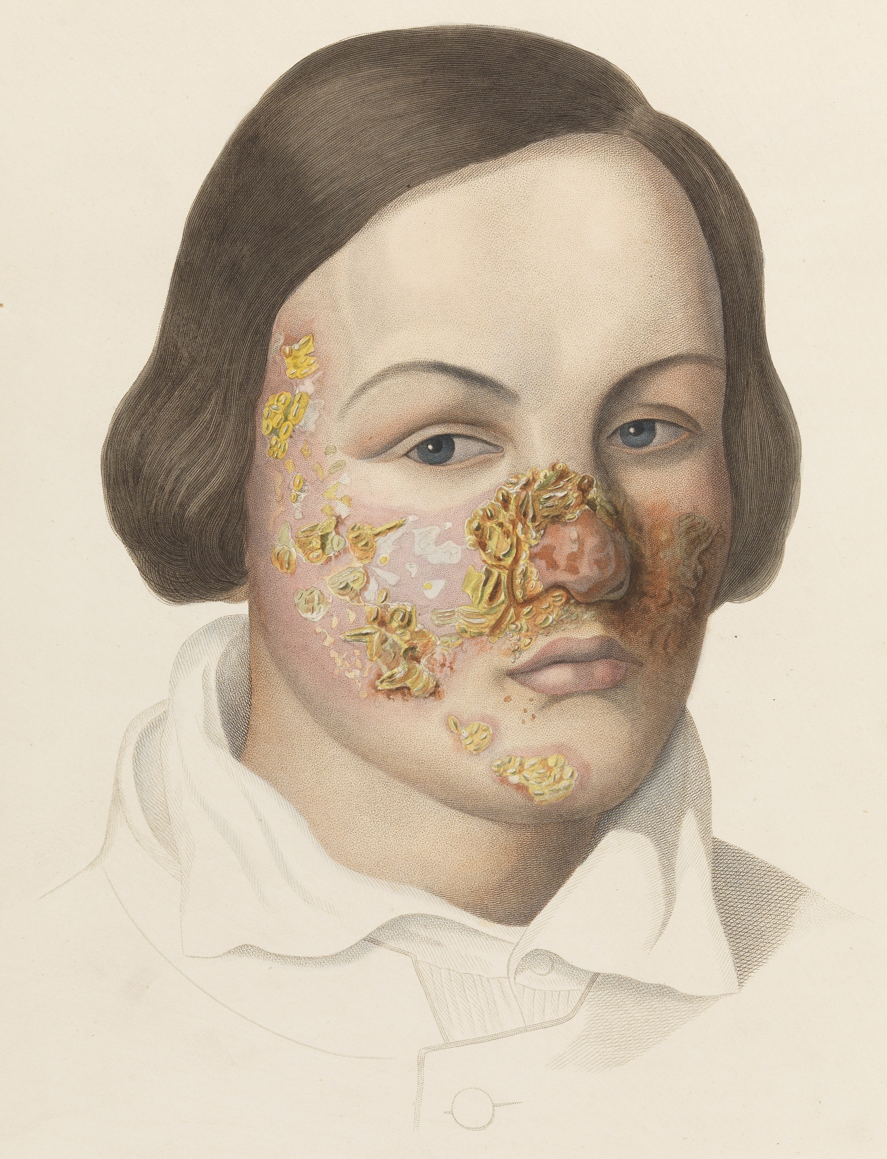 File:Woman's face infected with impetigo Wellcome L0074829 (cropped ...
