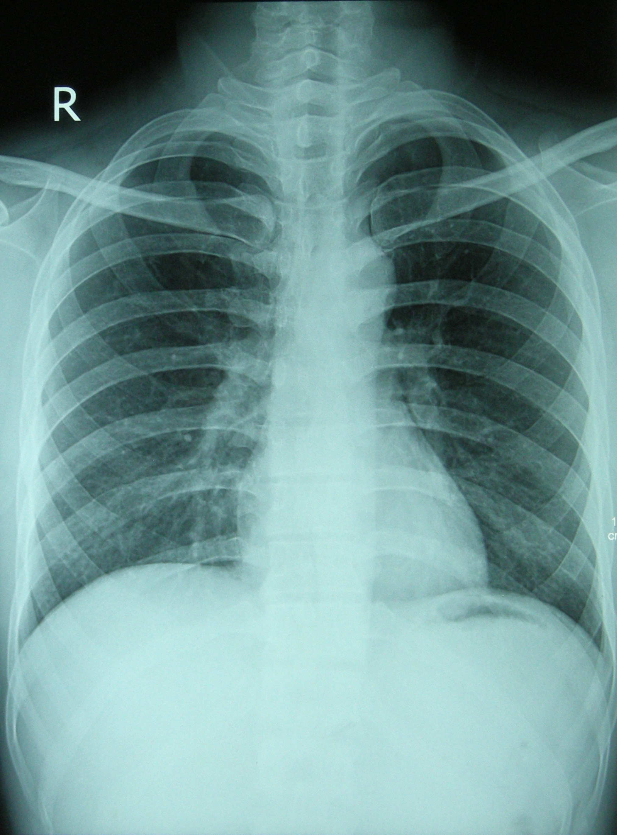 File:Chest X-ray 2346.jpg - Wikimedia Commons