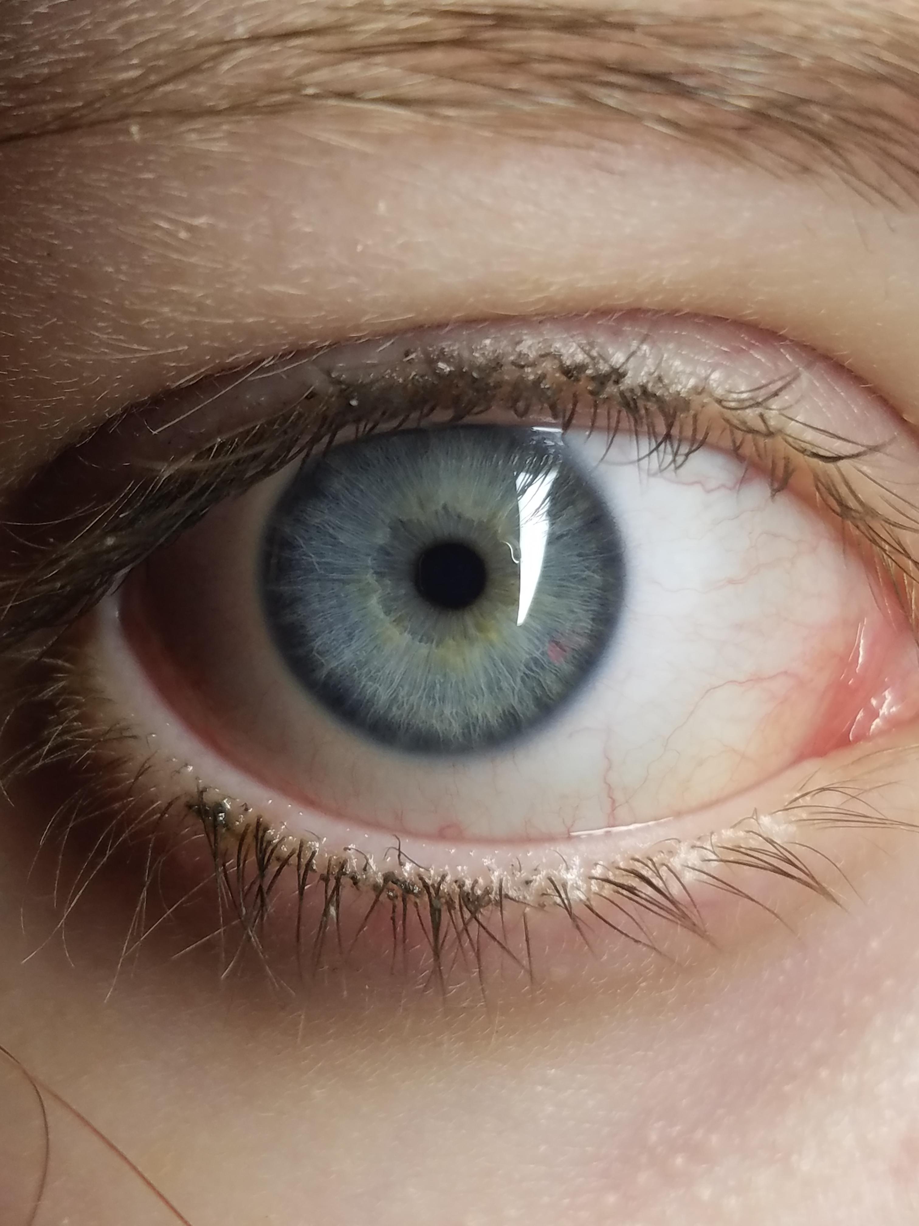 My blue and yellow eyes - Album on Imgur
